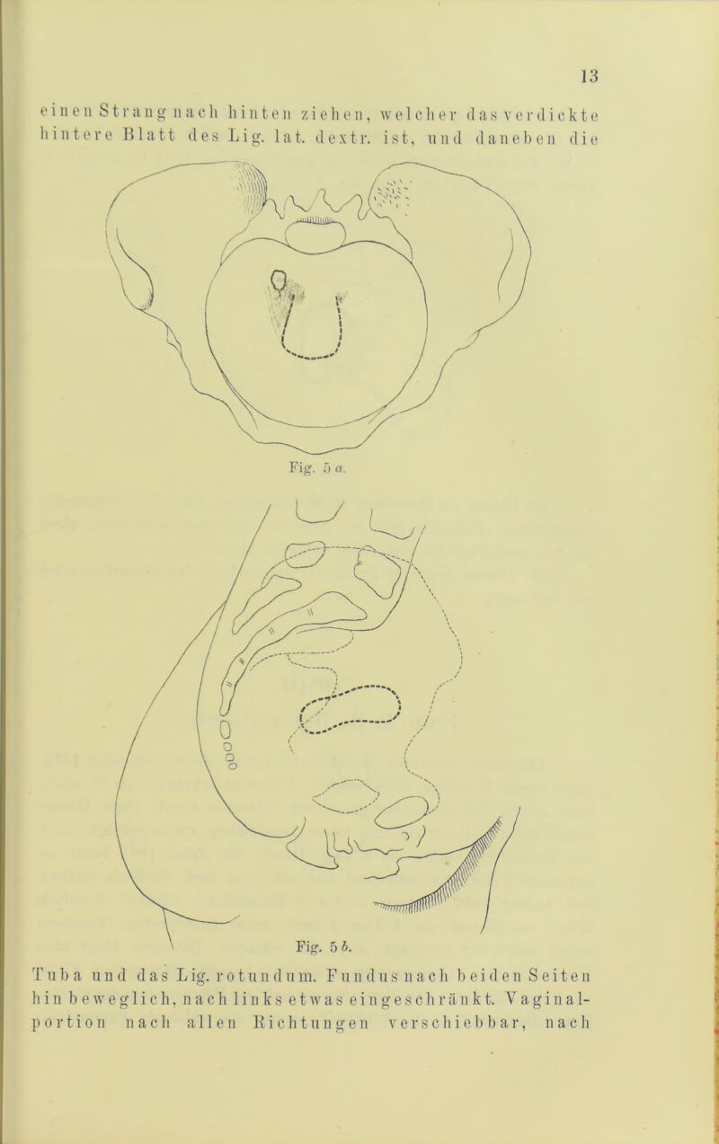 e i n 0 n S t r a ii g ii a c h li i n t o ii z i e li o n, w e 1 c li o r das verdickte hintere Blatt des Ijig. lat. dextr. ist, und daneben die T u 1) a und d a s L ig. r o t u n d u m. F ii n d u s n a c li 1) e i d e n Seite n li i 11 beweglich, nach links etwas e i n g e s c li r ä n k t. Vaginal- portion nach allen Kichtiingen verschiebbar, nach