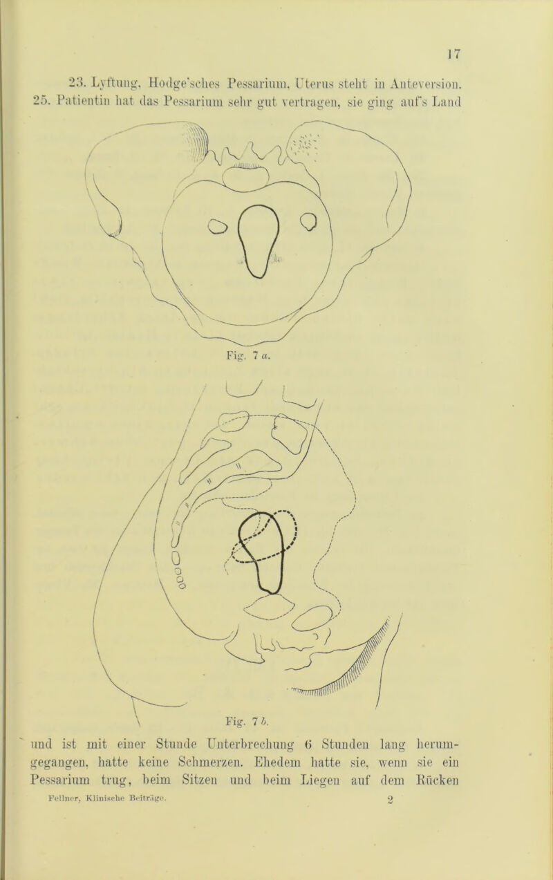 2.‘>. Lvt'tung'. Hotlo'e'schos Petisarium. Ptenis steht in Aiiteverslon. 25. Patientin hat das Pessarinin sehr gut vertragen, sie ging aufs Land und ist mit einer Stunde Unterbrecliung (> Stunden lang herum- gegaugen, liatte keine Schmerzen. Ehedem liatte sie. wenn sie ein Pessarium trug, beim Sitzen und beim Liegen auf dem Kücken VflliuT, Klinische Bcitr.'ifri?. 2