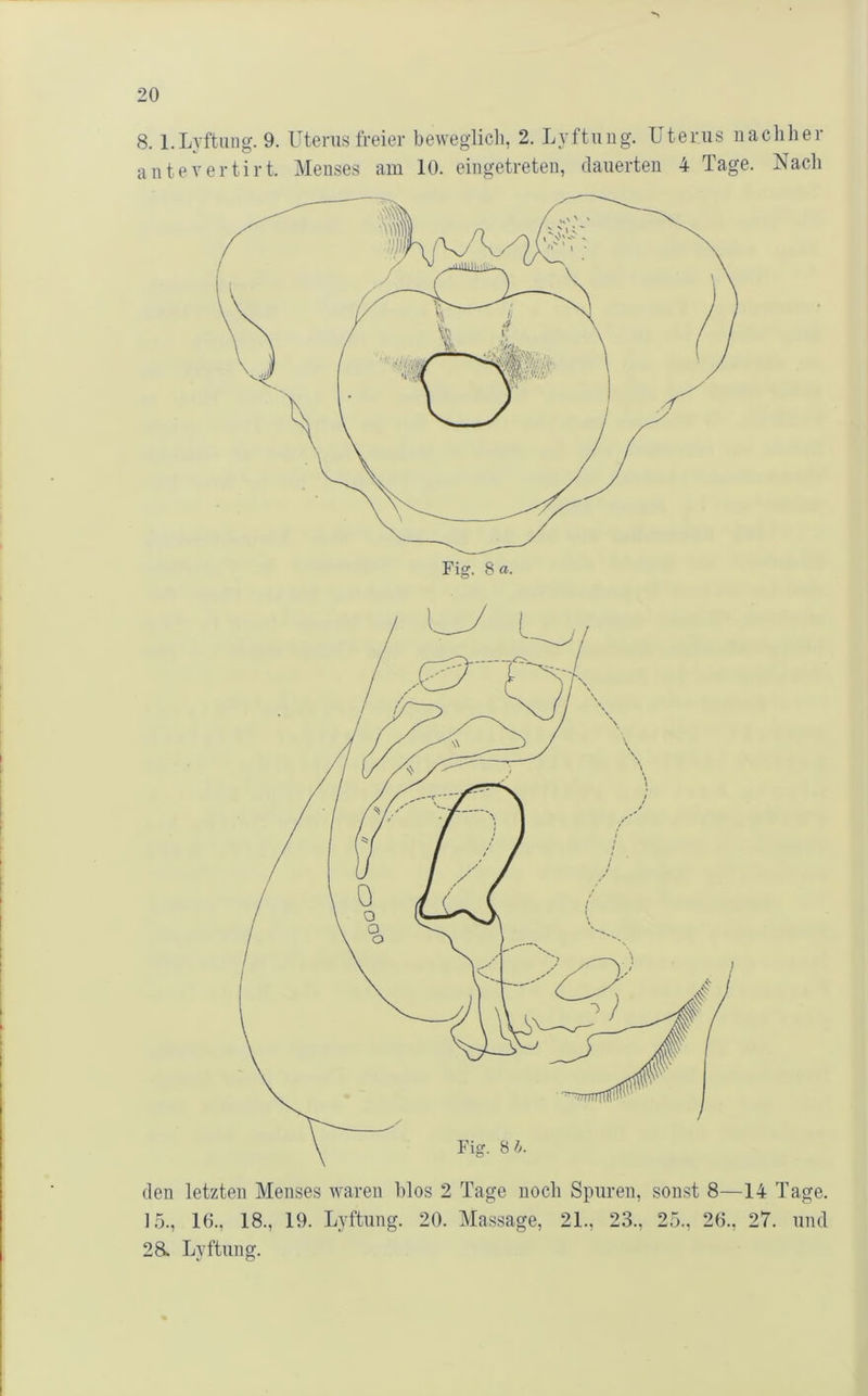 8. l.Lyftung. 9. Uterus freier beweglich, 2. Lyftuug. Uterus nachher autevertirt. Menses am 10. eingetreteii, dauerten 4 Tage. Nacli den letzten Menses waren hlos 2 Tage noch Spuren, sonst 8—14 Tage. 15., 16., 18., 19. Lyftung. 20. Massage, 21., 23., 25., 26., 27. und 28. Lyftung.