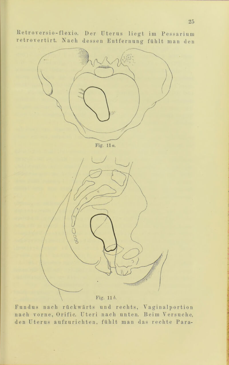 K e t r 0 V e r s i 0 - 11 e X i 0. Der U t e r ii s 1 i o g t i in D e s s a r i u in retro vertirt. Nach dessen K ntfernnng fühlt inan den F1111 d 11 s n a c li r n c k w ä r t s und r e c li t s, V a g i n a 1 p o r t i o n 11 ach V 0 r 11 e, (3 r i f i c. Uteri ii a c li ii n t e n. Bei in Vers n c li e. den Uterus a n fz ii r i c h t e n, fühlt man das i- e c li t e P a r a-