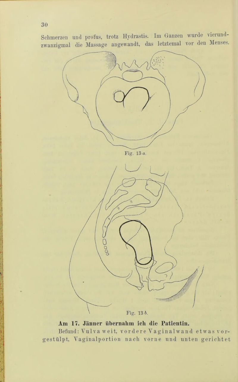 Schnierzeii mul profus, trotz Hydrastis. Im (laiizeu wurde \ieiund- zwanzigmal die Massage angewandt, das letztemal vor den Menses. Am 17. Jänner übernalini ich die Patientin. Befund: Vulva weit, vor d ere Vaginalwand etwas vor- gestülpt. Vaginalportion nach vorne und unten gerichtet