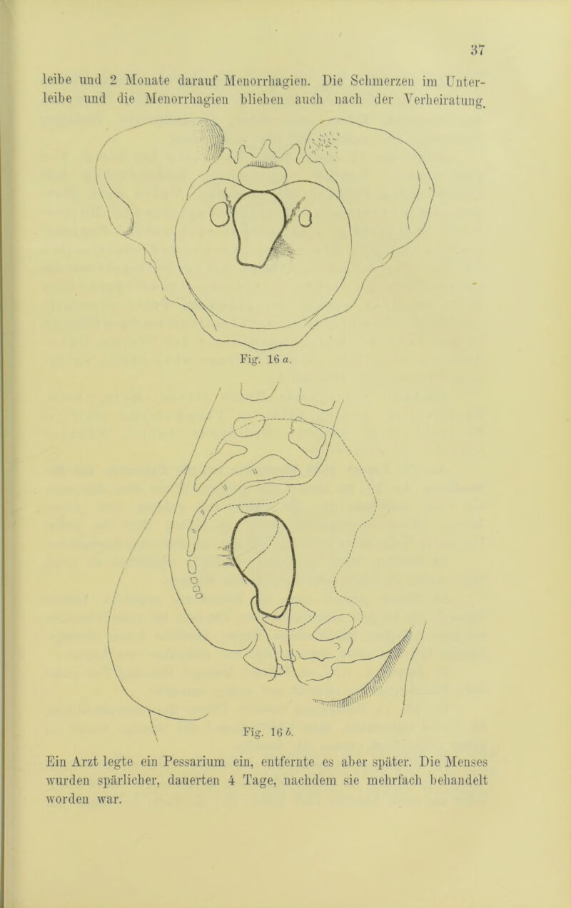 leibe und die Meiiorrhagieu bliel)en auch nach der Verlieiratuiio- ^ o* Ein Arzt legte ein Pessarium ein, entfernte es aber später. Die Menses wurden spärlicher, dauerten 4 Tage, nachdem sie mehrfach behandelt worden war.