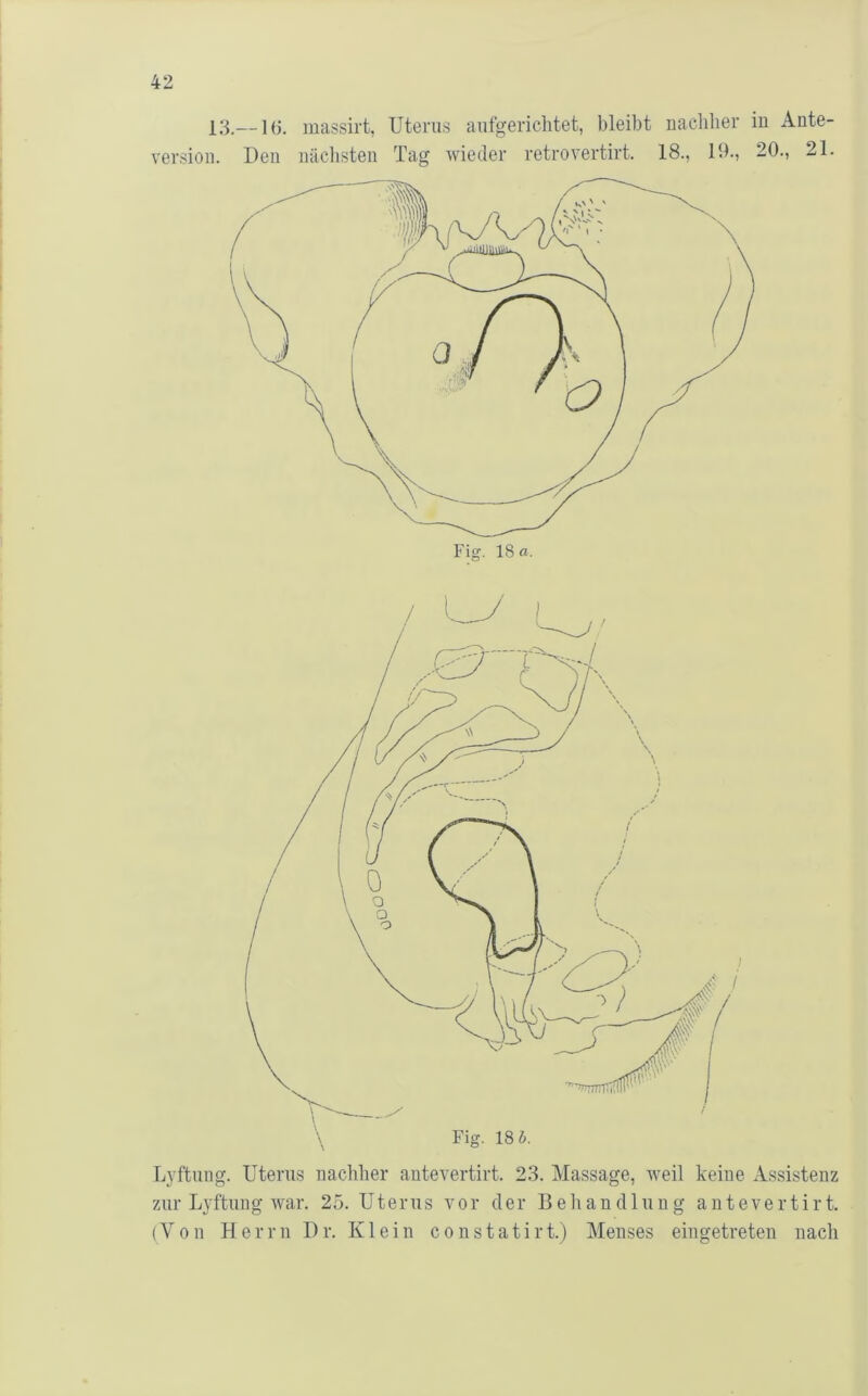 version. Den nächsten Tag wieder retrovertirt. 18., 19., 20., 21. Lyftung. Uterus nachher autevertirt. 23. Massage, weil keine Assistenz zur Lyftung war. 25. Uterus vor der Beliandlung autevertirt. (Von Herrn Dr. Klein constatirt.) Menses eiugetreten nach
