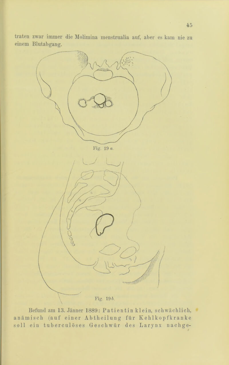 traten zwar immer die jMolimiiia meiistrualia auf, aber es kam nie zu einem Blutabgaim. o o Befund am 13. Jänner 1889: Patientin klein, scliwäcblicli, anämisch (auf einer Abtlieilung für Kehlkopfkrauke soll ein tuberculöses Be schwur des Larynx nach ge-
