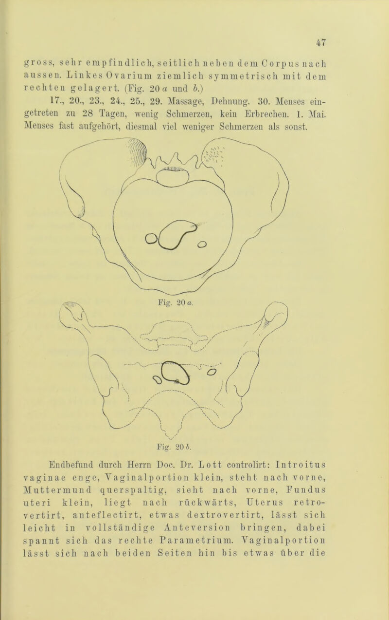 aussen. Liiikes 0a'arium ziemlich symmetrisch mit dem rechten gelagert. (Fig. 20a und h.) 17., 20., 23., 24., 25., 29. Massage, Dehnung. 30. Menses ein- getreten zu 28 Tagen, wenig Schmerzen, kein Erbrechen. 1. Mai. IMenses fast aufgehört, diesmal viel weniger Schmerzen als sonst. Endhefund durch Herrn Doc. Dr. Lott controlirt: Introitus vaginae enge. Vaginalportion klein, steht nach vorne, Muttermund querspaltig, sieht nach vorne, Fundus Uteri klein. Hegt nach rückwärts, Uterus retro- vertirt, anteflectirt, etwas dextrovertirt, lässt sich leicht in vollständige A n t e v e r s i o n bringen, dabei spannt sich das rechte Parametrium. Yaginalportion lässt sich nach beiden Seiten hin bis etwas über die