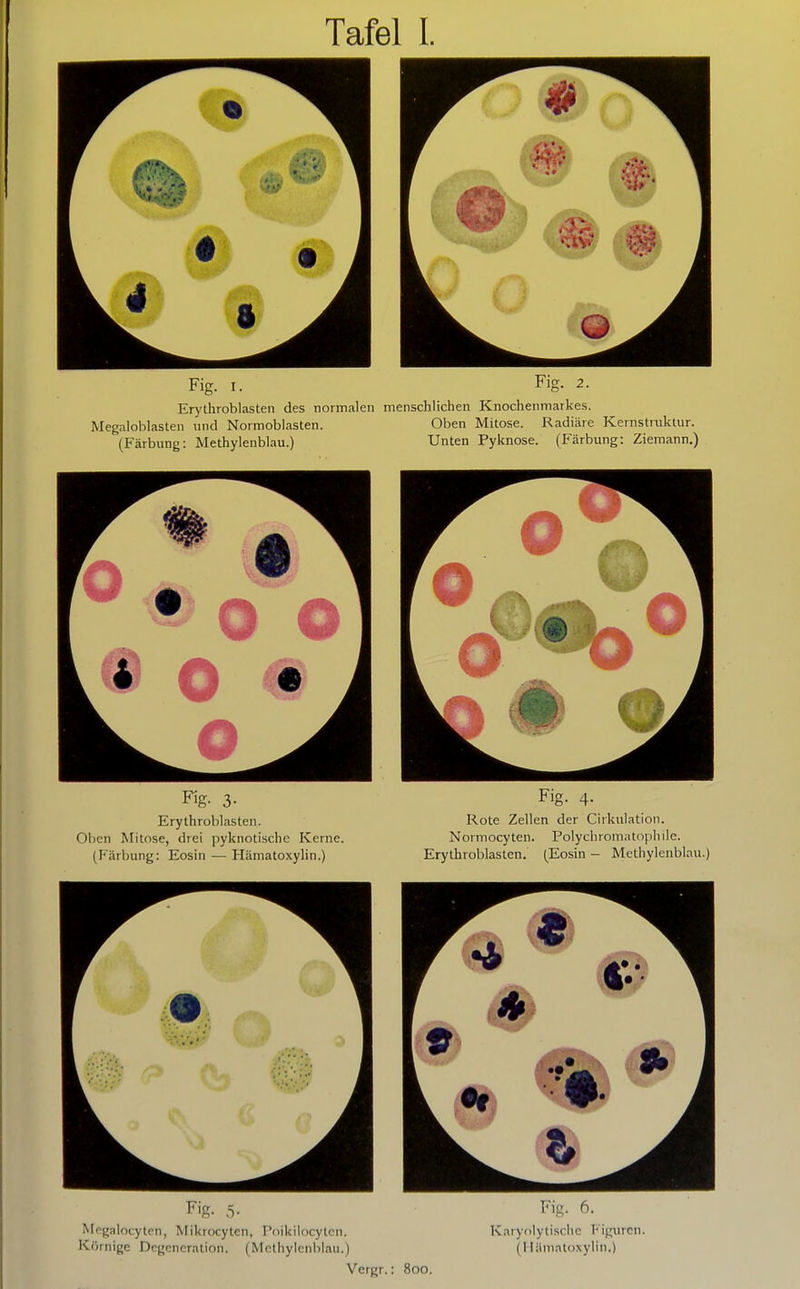 Tafel I. Fig. I. Erythroblasten des normalen menschlichen Knochenmarkes. Megaloblasten und Normoblasten. (Färbung: Methylenblau.) Oben Mitose. Radiäre Kernstruktur. Unten Pyknose. (Färbung: Ziemann.) Erythroblasten. Oben Mitose, drei pyknotische Kerne. (Färbung: Eosin — Hämatoxylin.) Fig. 4. Rote Zellen der Cirkulation. Normocyten. Polychromatophile. Erythroblasten. (Eosin - Methylenblau.) Fig. 5- Mo{;alocytpn, Mikrocyten, Poikilocytcn. Körnige Degeneration. (Methylenblau.) Fig. 6. Karyolytischc T'igmcn. (I liiniatoxylin.) Vergr.: 800.