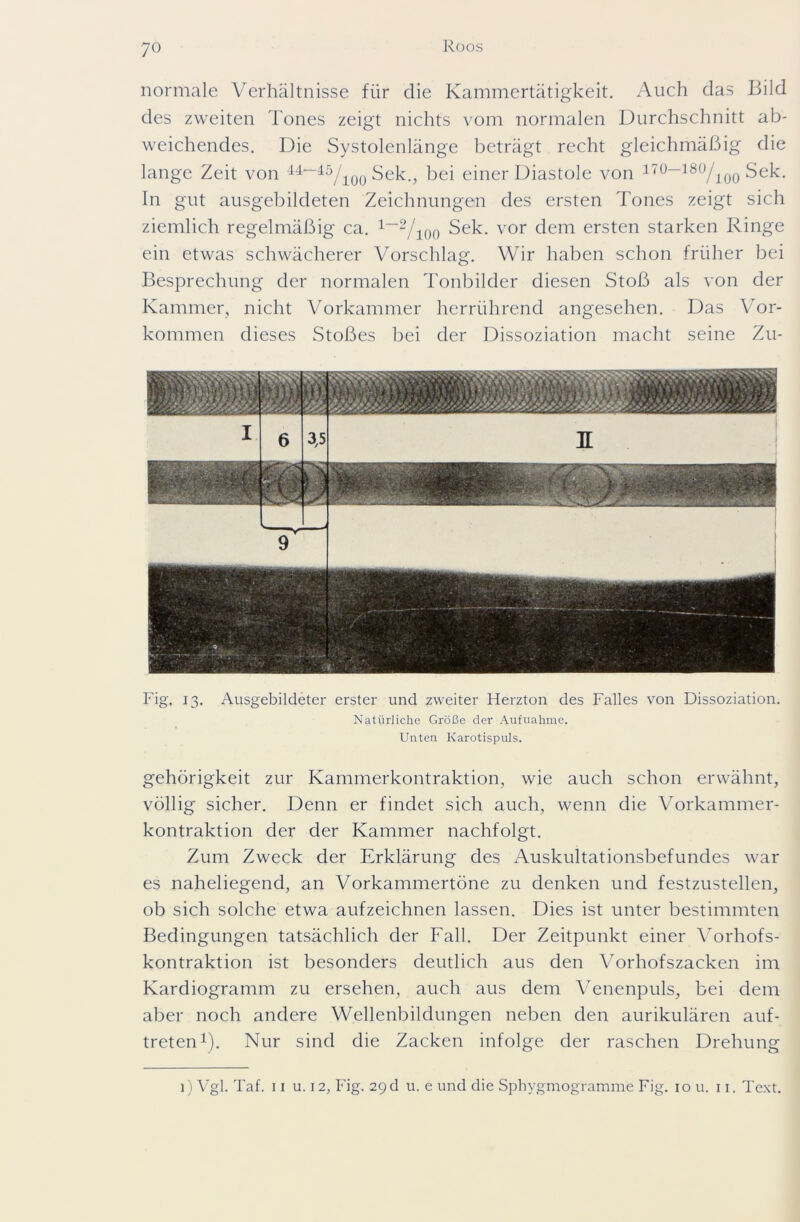 7 o normale Verhältnisse für die Kammertätigkeit. Auch das Bild des zweiten Tones zeigt nichts vom normalen Durchschnitt ab- weichendes. Die Systolenlänge beträgt recht gleichmäßig die lange Zeit von 44“45/lü0 Sek., bei einer Diastole von 1T°—18ü/100 Sek. In gut ausgebildeten Zeichnungen des ersten Tones zeigt sich ziemlich regelmäßig ca. 1—2/ioo Sek. vor dem ersten starken Ringe ein etwas schwächerer Vorschlag. Wir haben schon früher bei Besprechung der normalen Tonbilder diesen Stoß als von der Kammer, nicht Vorkammer herrührend angesehen. Das Vor- kommen dieses Stoßes bei der Dissoziation macht seine Zu- Fig. 13. Ausgebildeter erster und zweiter Herzton des Falles von Dissoziation. Natürliche Größe der Aufnahme. Unten Ivarotispuls. gehörigkeit zur Kammerkontraktion, wie auch schon erwähnt, völlig sicher. Denn er findet sich auch, wenn die Vorkammer- kontraktion der der Kammer nachfolgt. Zum Zweck der Erklärung des Auskultationsbefundes war es naheliegend, an Vorkammertöne zu denken und festzustellen, ob sich solche etwa aufzeichnen lassen. Dies ist unter bestimmten Bedingungen tatsächlich der Fall. Der Zeitpunkt einer Vorhofs- kontraktion ist besonders deutlich aus den Vorhofszacken im Kardiogramm zu ersehen, auch aus dem Venenpuls, bei dem aber noch andere Wellenbildungen neben den aurikulären auf- treten1). Nur sind die Zacken infolge der raschen Drehung