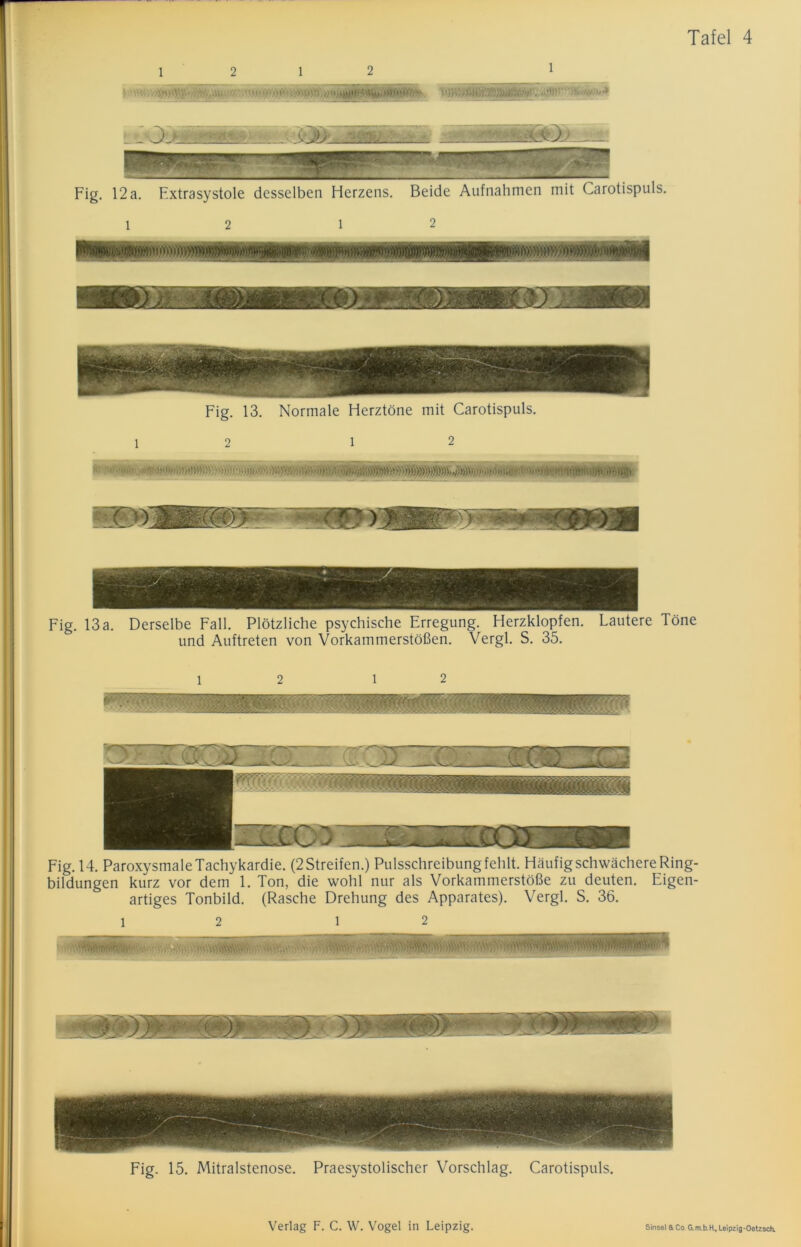 i .K..UI II.. .1 ■ r-; . ..i,,.!. • /l.., . _ ') > ■■ ■ • - (• ». zmte**** ^£ÄS?SäÖ0j i Fig. 12 a. Extrasystole desselben Herzens. Beide Aufnahmen mit Carotispuls. 12 12 Fig. 13. Normale Herztöne mit Carotispuls. 12 12 »’W'.'Mrti • ww .’.WWWÖV,• V- .»• • ,n.;j;;»y»^>V>>%>>>)^>)(>>^))>,i»'*• - ‘ - Fig. 13a. Derselbe Fall. Plötzliche psychische Erregung. Herzklopfen. Lautere Töne und Auftreten von Vorkammerstößen. Vergl. S. 35. 12 12 Fig. 14. Paroxysmale Tachykardie. (2Streifen.) Pulsschreibungfehlt. Häufig schwächere Ring- bildungen kurz vor dem 1. Ton, die wohl nur als Vorkammerstöße zu deuten. Eigen- artiges Tonbild. (Rasche Drehung des Apparates). Vergl. S. 36. l mmmw'- 1 2 Fig. 15. Mitralstenose. Praesystolischer Vorschlag. Carotispuls.
