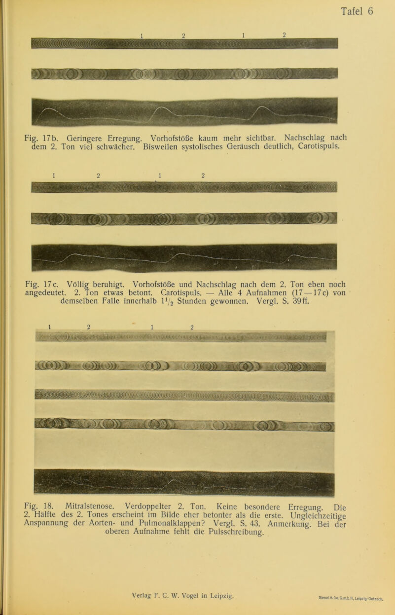 Fig. 17b. Geringere Erregung. Vorhofstöße kaum mehr sichtbar. Nachschlag nach dem 2. Ton viel schwächer. Bisweilen systolisches Geräusch deutlich, Carotispuls. l 2 2 Fig. 17 c. Völlig beruhigt. Vorhofstöße und Nachschlag nach dem 2. Ton eben noch angedeutet. 2. Ton etwas betont. Carotispuls. — Alle 4 Aufnahmen (17—17c) von demselben Falle innerhalb llj2 Stunden gewonnen. Vergl. S. 39ff. l 2 . l 2 £03 sJl Fig. 18. Mitralstenose. Verdoppelter 2. Ton. Keine besondere Erregung. Die 2. Hälfte des 2. Tones erscheint im Bilde eher betonter als die erste. Ungleichzeitige Anspannung der Aorten- und Pulmonalklappen? Vergl. S. 43. Anmerkung. Bei der oberen Aufnahme fehlt die Pulsschreibung.