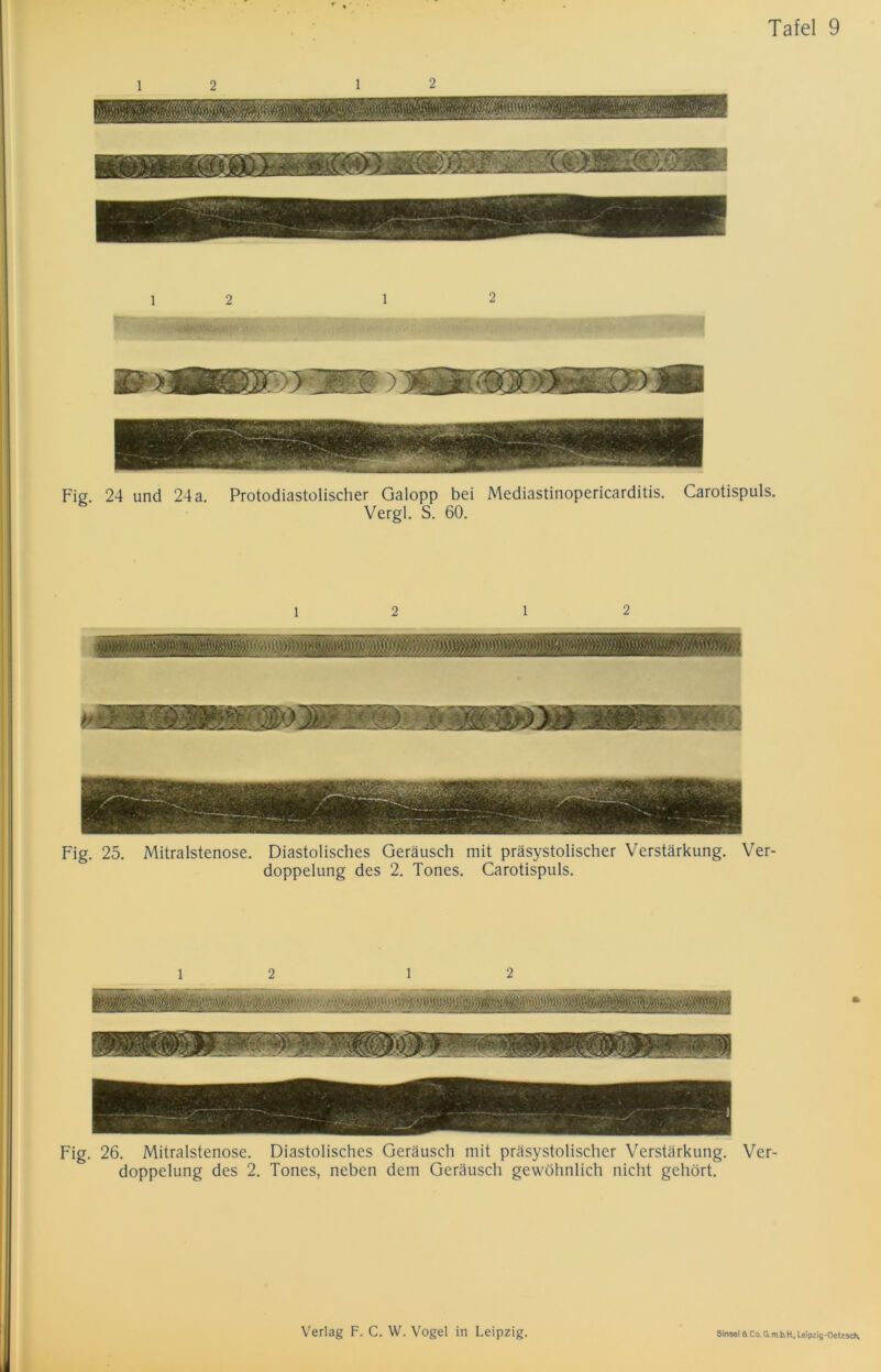 12 12 Fig. 24 und 24a. Protodiastolischer Galopp bei Mediastinopericarditis. Carotispuls. Vergl. S. 60. l 2 Fig. 25. Mitralstenose. Diastolisches Geräusch mit präsystolischer Verstärkung. Ver- doppelung des 2. Tones. Carotispuls. l Fig. 26. Mitralstenose. Diastolisches Geräusch mit präsystolischer Verstärkung. Ver- doppelung des 2. Tones, neben dem Geräusch gewöhnlich nicht gehört.