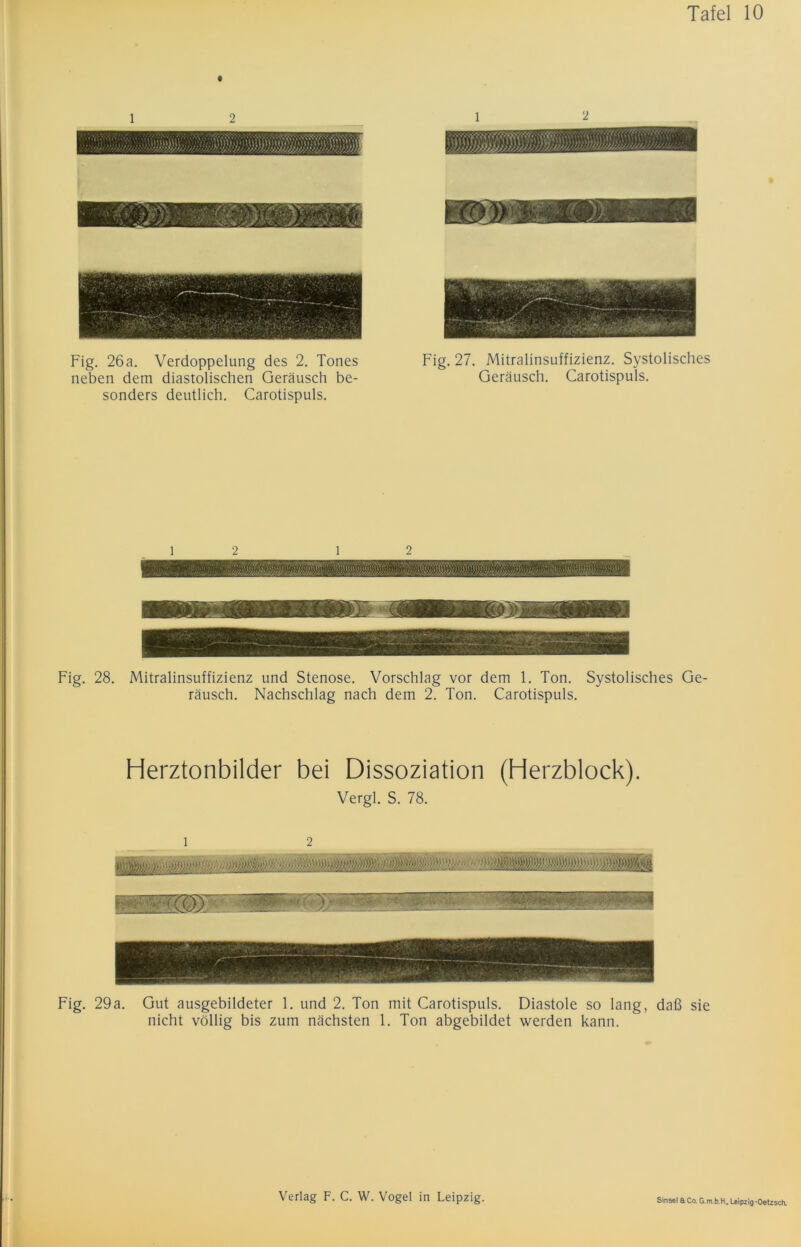 Fig. 26a. Verdoppelung des 2. Tones neben dem diastolischen Geräusch be- sonders deutlich. Carotispuls. Fig. 27. Mitralinsuffizienz. Systolisches Geräusch. Carotispuls. Fig. 28. Mitralinsuffizienz und Stenose. Vorschlag vor dem 1. Ton. Systolisches Ge- räusch. Nachschlag nach dem 2. Ton. Carotispuls. Herztonbilder bei Dissoziation (Herzblock). Vergl. S. 78. Fig. 29a. Gut ausgebildeter 1. und 2. Ton mit Carotispuls. Diastole so lang, daß sie nicht völlig bis zum nächsten 1. Ton abgebildet werden kann.