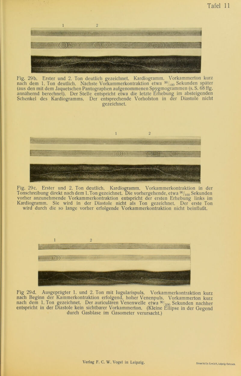 1 2 Fig. 29b. Erster und 2. Ton deutlich gezeichnet. Kardiogramm. Vorkammerton kurz nach dem 1. Ton deutlich. Nächste Vorkammerkontraktion etwa 00 Sekunden später (aus den mit dem Jaquetschen Pantographen aufgenommenen Spygmogrammen (s. S. 68 ffg. annähernd berechnet). Der Stelle entspricht etwa die letzte Erhebung im absteigenden Schenkel des Kardiogramms. Der entsprechende Vorhofston in der Diastole nicht gezeichnet. 2 Fig. 29c. Erster und 2. Ton deutlich. Kardiogramm. Vorkammerkontraktion in der Tonschreibung direkt nach dem l.Ton gezeichnet. Die vorhergehende, etwa 90/l00 Sekunden vorher anzunehmende Vorkammerkontraktion entspricht der ersten Erhebung links im Kardiogramm. Sie wird in der Diastole nicht als Ton gezeichnet. Der erste Ton wird durch die so lange vorher erfolgende Vorkammerkontraktion nicht beinflußt. l 2 Fig 29d. Ausgeprägter 1. und 2. Ton mit Iugularispuls. Vorkammerkontraktion kurz nach Beginn der Kammerkontraktion erfolgend, hoher Venenpuls. Vorkammerton kurz nach dem l.Ton gezeichnet. Der auriculären Venenwelle etwa 90/100 Sekunden nachher entspricht in der Diastole kein sichtbarer Vorkammerton. (Kleine Ellipse in der Gegend durch Gasblase im Gasometer verursacht.)