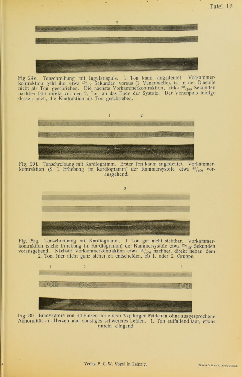 1 2 Fig 29 e. Tonschreibung mit lugularispuls. 1. Ton kaum angedeutet. Vorkammer- kontraktion geht ihm etwa 45/ioo Sekunden voraus (1. Venenwelle), ist in der Diastole nicht als Ton geschrieben. Die nächste Vorkammerkontraktion, zirka ^/ioo Sekunden nachher fällt direkt vor den 2. Ton an das Ende der Systole. Der Venenpuls infolge dessen hoch, die Kontraktion als Ton geschrieben. l 2 t ■HKS Fig. 29f. Tonschreibung mit Kardiogramm. Erster Ton kaum angedeutet. Vorkammer- kontraktion (S. 1. Erhebung im Kardiogramm) der Kammersystole etwa 47/aoo vor- ausgehend. 2 • • •’ ■■ ' ■ -V. ~ Fig. 29 g. Tonschreibung mit Kardiogramm. E Ton gar nicht sichtbar. Vorkammer- kontraktion (siehe Erhebung im Kardiogramm) der Kammersystole etwa 25/l00 Sekunden vorausgehend. Nächste Vorkammerkontraktion etwa 90/l00 nachher, direkt neben dem 2. Ton, hier nicht ganz sicher zu entscheiden, ob 1. oder 2. Gruppe. l 2 l Fig. 30. Bradykardie von 44 Pulsen bei einem 25 jährigen Mädchen ohne ausgesprochene Abnormität am Herzen und sonstiges schwereres Leiden. E Ton auffallend laut, etwas unrein klingend.
