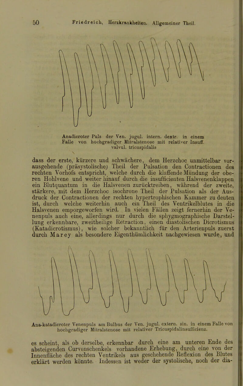 Anadicroter Puls der Ven. jugul. intern, dextr. in einem Falle von hochgradiger Mitralstenose mit relativer InsuiF. valvul. tricuspidalis dass der erste, kürzere und schwächere, dem Herzchoc unmittelbar vor- ausgehende (präsystolischej Theil der Pulsation den Contractionen des rechten Vorhofs entspricht, welche durch die klaffende Mündung der obe- ren Hohlvene und weiter hinauf durch die insufficienten Halsvenenklappen ein Blutquantum in die Halsvenen zurücktreiben, während der zweite, stärkere, mit dem Herzchoc isochrone Theil der Pulsation als der Aus- druck der Contractionen der rechten hypertrophischen Kammer zu deuten ist, durch welche weiterhin auch ein Theil des Ventrikelblutes in die Halsvenen emporgeworfen wird. In vielen Fällen zeigt fernerhin der Ve- nenpuls auch eine, allerdings nur durch die sphygmographische Darstel- lung erkennbare, zweitheilige Eetraction, einen diastolischen Dicrotismus (Katadicrotismus), wie solcher bekanntlich für den Arterienpuls zuerst durch Marey als besondere Eigenthümlichkeit nachgewiesen wurde, und Ana-katadicroter Venenpuls am Bulbus der Ven. jugul. extern, sin. in einem Falle von hochgradiger Mitralstenose mit relativer Tricuspidalinsuflicienz. es scheint, als ob derselbe, erkennbar durch eine am unteren Ende des absteigenden Curvenschenkels vorhandene Erhebung, durch eine von der Innenfläche des rechten Ventrikels aus geschehende Reflexion des Blutes erklärt werden könnte. Indessen ist weder der systolische, noch der dia-