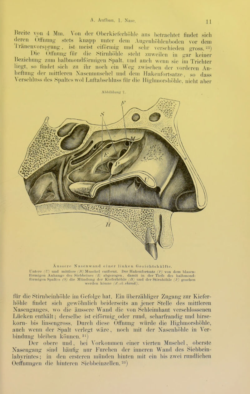 l>reite von 4 Mm. Wm der OhcM-kiotrrlii.lilo aus hetraclitct findet sicli (leron Ortnunn- stots knapp unter (Kmu Aui;vnIii'.lil('n))(Kl('n vor dem 'l'ränenvorsprunii'. ist meist eifitnui,:;' und sehr versefiieden ;;-ross. Die Otlnunii' für die Stirnliölde steht zuweih'n in i;ar keiner Ue/iehnni;- /um haH)mondt'()rmii;en Spalt, r-nd auch wenn sie im Trichter liei;t. so lin(h't sieh /u ihr noch ein Wcj; /wisehen (Um- vorderen An- hethinji' der mittkM-en X asenmiisehe! und (Umu Hakentortsatze. so dass Verschluss des Spaltes wol Lut'tal)schluss für die ilii;hiiiorsh(»hle. nicht aber .Miliilduiij; 7. Äussi'i'f Nasonwarifl cinpr liiikpii (i c s i o Ii t s Ii ä 1 f t c. l'ntere (tj uiul inittlcrc (Muschel entfernt. Der Hakenfortsatz (I') von dem lilasen- forniitfen Anhange des Sielibeiues (A' al)ji;e/,()n;en, damit in der Tiefe des luillimond- fiirmiifen S|ialt;'s fS) die Mündung der Kieferhöhle {//) und der Stirnhöhle (/•') gesehen werden könne i /. .ck.rkandij. für die Stirnbeinlirdile im Gefol^'e hat. Ein überzähli^-er Zn^-anj;' zur Kiefer- höhle fin(kt sich ji'ewfdnilich beiderseits an jener Stelle (les mittleren Nasenpmü'es. wo die äussere V\ and di(; von Schleimhaut verscldosseneii Lücken enthält; (U'rselbe ist cit'örmi«;- oder rund, schart'randij;-und hirse- korn- bis linsenj4ross. Durch diese Otthuni;' würde die Hig'lnnorsh()hle, aucli wenn der Spalt verle<;-t wäre, noch mit der Nasenliidile in Ver- l)indnnii bleiben können.'^') Der (d)ere und. bei ^'orkoInmen einer vierten Muschel, oberste Nasen^-anii' sind häufi«;' nur Furchen der inneren Wand des Siebbein- labyrintes; in (hMi ersteren münchMi hinten mit ein bis zwei rundlichen Oeft'nnngen die hinteren Siebbeinzellen.-•'')