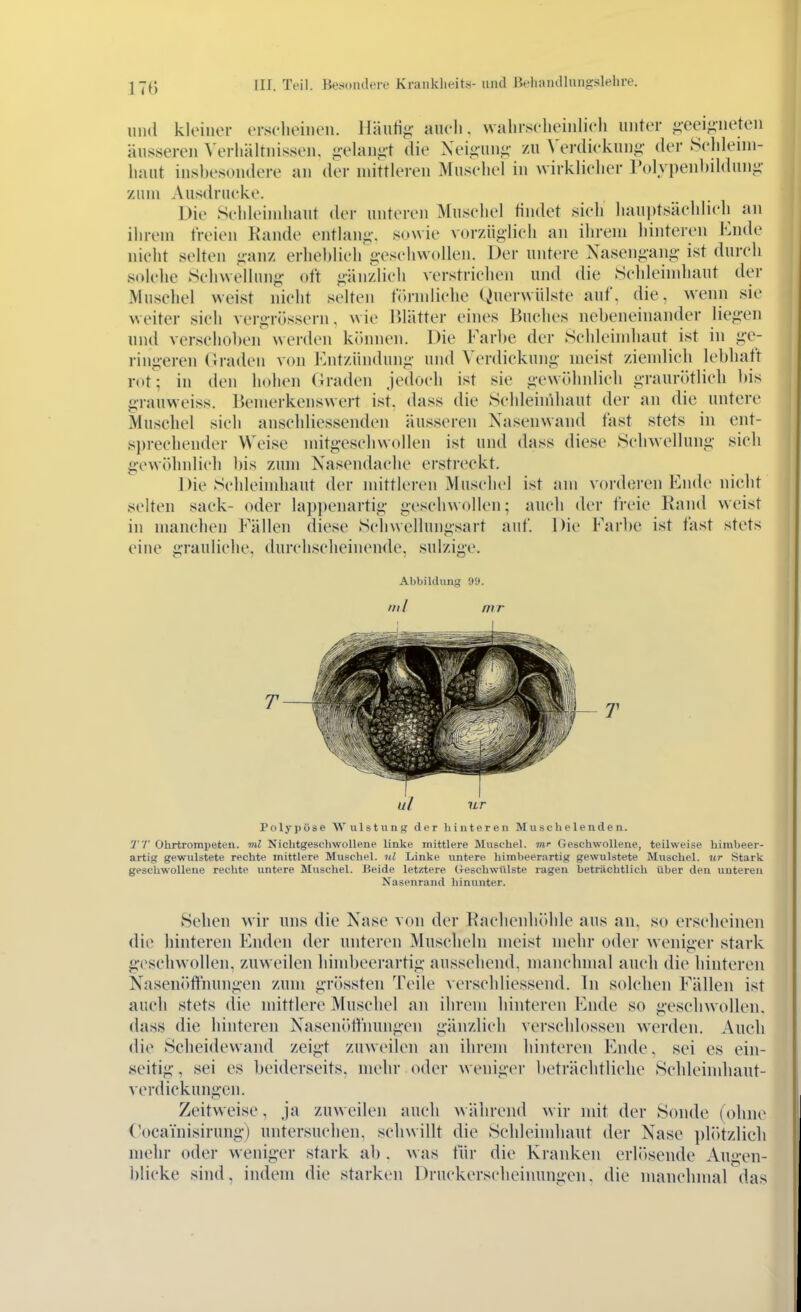 1111(1 kloilior tTsclioiiieii. Häuti<;' auch, walirseheinlicli unter ^•eei^iiieten äusseren \'erliälrnisseii. ^ivlaii^t die Xeiouni;- zu ^'erdiekung• der Sclilemi- haut insbesondere an der mittleren Museliel in wirklielier Polypenbildunii- zum Ausdrucke. Die Sclileiniiiaut der unteren Muschel tindet sich hauptsächlich an ihrem freien Kaiide entlang-, sowie vorzüglich an ihrem hinteren Ende nicht selten «ianz erheblich o-eschwollen. Der untere Nasengang- ist durch solelie Schwellung oft gänzlich verstrichen und die Sclileiinhaut der Muschel weist nicht selten fi»rinliche Querwülste auf, die, wenn sie w eiter sich vergrössern. w ie Blätter eines Buches nebeneinander liegen und verschoben werden können. Die Farlie der Schleimhaut ist in ge- ringeren (iraden von Entzündung und Verdickung meist ziendieh lebhaft rot; in den hohen Graden jedoch ist sie gewJdinlicli graurötlich bis grauweiss. Bemerkenswert ist, dass die Sclileiinhaut der an die untere Muschel sich anschliessenden äusseren Xasenwand fast stets in cnt- si)rechender Weise mitgeschwollen ist und dass diese Schwellung sich gewöhnlich l)is zum Nasendache erstreckt. Die Schleimhaut der mittleren Muschel ist am vorderen Ende nicht selten sack- oder lapi)enartig geschwollen; auch der freie Rand weist in manchen Fällen diese Schwellungsart auf. Die Farbe ist fast stets eine grauliche, durchscheinende, sulzige. Abbildung 99. Uli mr T 1 ul ur Polypöse Wulstiing der hinteren Muschelenden. 7/' Ohrtrompeten, ml Nichtgeschwollene linke mittlere Muschel, mr Geschwollene, teilweise himbeer- artig gewulstete rechte mittlere Muschel, nl Linke untere himbeerartig gewulstete Muschel, ur Stark geschwollene rechte untere Muschel. Beide letztere Oeschwülste ragen beträchtlich über den unteren Nasenrand hinunter. Sehen wir uns die Nase von der Kachenludile aus an, so erscheinen die hinteren Enden der unteren Muscheln meist mehr oder w eniger stark geschwollen, zuw eilen hinibeerartig ausseliend, manchmal auch die hinteren Nasenöftiiungen zum grössten Teile verschliessend. In solchen Fällen ist auch stets die mittlere Museliel an ihrem hinteren Ende so geschwollen, dass die hinteren Nasenölfnungen gänzlich verschlossen werden. Auch die Scheidewand zeigt zuweilen an ihrem hinteren Ende, sei es ein- seitig, sei es beiderseits, mehr oder weniger beträchtliche Selileimhaut- verdickungen. Zeitweise, ja zuweilen auch während wir mit der Sonde (ohne Cocainisirung) untersuchen, schwillt die Schleimhaut der Nase pliUzlich mehr oder weniger stark ab . w as für die Kranken erl(»sende Augen- blicke sind, indem die starken Druckerscheinungen, die manchmal das
