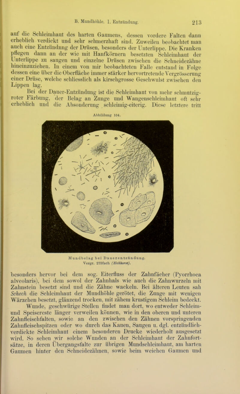 auf die Schleiiiihaiit des harten Gaumens, dessen vordere Falten dann erheblieh verdiekt und selir schmerzhaft sind. Zuweilen beol)aehtet man auch eine Entzündniiii- der Drüsen, besonders der Unternpi)e. Die Kranken ptie^-en dann an der wie mit Ilanfkörnern besetzten ►Sehhnmhaut der Unterlippe zu saugen und einzelne Drüsen zwischen die »Schneidezähne hineinzuziehen. In einem von mir beobachteten Falle entstand in Folge dessen eine über die Oberfläche immer stärker hervortretende \'ergrösserung einer Drüse, welche schliesslich als kirschg-rosse Geschwulst zwischen den Lippen lag. Bei der Dauer-Entzündung ist die Schleimhaut von mehr schmutzig- roter Färbung, der Belag an Zunge und Wangenschleimhant oft sehr erhel)lich und die Absonderung schleimig-eiterig. Diese letztere tritt Abbildung 104. Mundbelag bei Dauerentzündung. Vergr. 275fach (Eichhorst). besonders hervor Ijei dem sog. Eiterfluss der Zahnfächer (Pyorrlioea alveolaris), bei dem sowol der Zahnhals w'ie auch die Zahnwurzeln mit Zahnstein besetzt sind und die Zähne wackeln. Bei älteren Leuten sah Scheck die Schleimhaut der Mundhöhle gerötet, die Zunge mit wenigen Wärzchen besetzt, glänzend trocken, mit zähem krustigem Schleim bedeckt, Wunde, geschwürige Stellen flndet man dort, wo entweder Sclileim- und Speisereste länger verweilen können, wie in den oberen und unteren Zahnfleischfalten, sowie an den zwischen den Zähnen vorspringenden Zahnfleischspitzen oder wo durch das Kauen, Saugen u. dgl. entzündlich- verdickte Schleimhaut einem besonderen Drucke wiederholt ausgesetzt wird. So sehen wir solche Wunden an der Schleimhaut der Zahnfort- sätze, in deren Übergangsfalte zur übrigen Mundschleimhaut, am harten Gaumen hinter den Schneidezähnen, sowie beim weichen Gaumen und