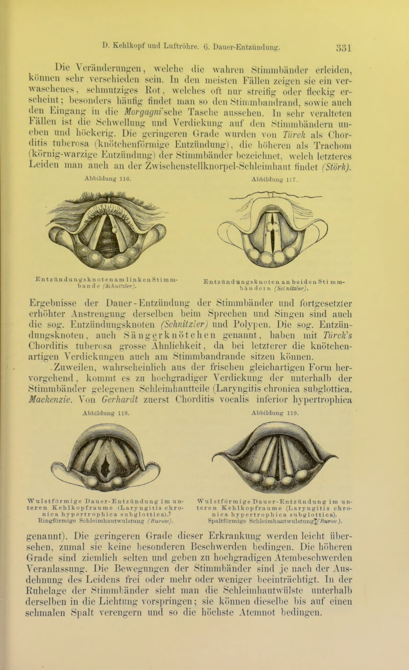 Die Verälulermiii-en, welche die Avahren Stiiiimbäiuler erleiden, koiiueu sehr verj^chieden sein. In den meisten Fällen zei^.i-en sie ein ver- waschenes, sclnnutziiies Rot, welches oft nur strcitii;- oder fleckig- er- scheint ; besonders häutii;- findet man so den ^timmbandrand, sowie anch in die Morgagni »che Tasche aussehen. In sehr veralteten Fällen ist die .Schwelhini;' und Verdickung- auf den Stimmbändern un- eben und luickerig. Die geringeren Grade wurden von Tiirck als Chor- ditis tuberosa (knötchenfdrmige Entzündung), die höheren als Trachom (körnig-warzige Entzündung) der Stinnnbänder bezeichnet, welch letzteres Leiden man auch an der Zwischenstellknorpel-Schleimhaut findet (Stork). Abbildung llG. Abbilduiig 117. Entzündungsknotenamllnke 11 Stimm- bande (i)ihiiifzler). Entzündungskuoten an beiden Sti mra- biiii doi II (Scl.llitzler). Ergebnisse der Dauer-Entzündung der Stimmbänder und fortgesetzter erhöhter Anstrengung derselben beim Sprechen und Singen sind auch die sog, Entzündungsknoten (Schnitzler) und Polypen. Die sog. Entzün- dungsknoten, auch Sängerknötchen genannt, haben mit Türck's Cliorditis tuberosa grosse Ähnlichkeit, da bei letzterer die knötchen- artigen ^'erdiekungen auch am Stimmbandrande sitzen können. .Zuweilen, wahrscheinlich ans der frischen gleichartigen Form her- vorgehend . kommt es zn hochgradiger Verdickung der unterhalb der Stimmbänder gelegenen Schleimhautteile (Laryngitis chronica subglottica. Mackenzie. Von Gerhardt zuerst Cliorditis vocalis inferior hypertrophica Abbildung 118. Abbildung 119. Wulstförmige Dauer-Entzündung Im un- WulstförmigeDauer-Entzündung im un- teren Kehlkopfraume (Laryngitis chro- teren K eh Ik op f r au m e (Laryngitis chro- nica hypertrophica subglottica).. n i c a h y ii e r t r o p Ii i c a s u Ii g 1 o 11 i c a). Ringförmige Schleimhautwulstung (Htirov;). Spaltförmige SclileimluuitwulstungTfßurowJ. genannt). Die geringeren Grade dieser Erkrankung werden leicht über- sehen, zumal sie keine besonderen Beschwerden bedingen. Die höheren Grade sind ziemlich selten und geben zu hochgradigen Atembeschwerden Veranlassung. Die Bewegungen der Stimmbänder sind je nach der Aus- dehnung des Leidens frei oder mehr oder weniger beeinträchtigt. In der Rnhelao-e der Stimmbänder sieht man die Schleimhautwülste unterhalb derselben in die Lichtung vorspringen; sie können dieselbe bis auf einen schmalen Spalt verengern und so die höchste Atemnot bedingen.