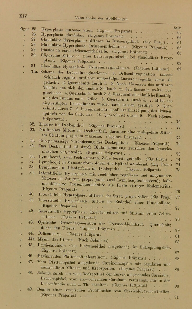 Verzeichniss der Abbildungen Figur 25. Hyperplasia mucosae uteri. (Eigenes Präparat) * 26. Hyperplasia glandulär. (Eigenes Präparat) „ 27. Glanduläre Hyperplasie; Mitosen im Drüsenepithel. (Eig. Präp.) . '  28- Glanduläre Hyperplasie; Drüsenepithelmitose. (Eigenes Präparat.)  29. Diaster in einer Drüsenepitholzelle. (Eigenes Präparat) ” 30' Ghgosome Mitose in einer Drüsenepithelzelle bei glandulärer Hyper- plasie. (Eigenes Präparat) r> r 31. Glanduläre Hyperplasie; Drüseninvaginationen. (Eigenes Präparat) 31a. Schema der Drüseninvaginationen: 1. Drüseninvagination; innerer Schlauch regulär, mittlerer umgestülpt, äusserer regulär, etwas ab- geflacht. 2. Querschnitt durch 1. 8. Nach Abreissen des mittleren Tlieiles hat sich der innere Schlauch in den äusseren weiter vor- geschoben. 4. Querschnitt durch 8. 5. Flaschenhodenähnliche Einstülp- ung des Fundus einer Drüse. 6. Querschnitt durch 5. 7. Mitte des eingestülpten Drüsenfundus wieder nach aussen gestülpt. 8. Quer- schnitt durch 7. 9. Intraglanduläre papilläre Einstülpung des Drüsen- epithels von der Seite her. 10. Querschnitt durch 9. (Nach eigenen Präparaten) v 32. Diaster im Deckepithel. (Eigenes Präparat) ’ 33’ MultlP°lare Mit°se im Deckepithel, darunter eine multipolare Mitose im Stratum proprium mucosae. (Eigenes Präparat) ’ J?4’ Unregelmässige Veränderung des Deckepithels. (Eigenes Präparat.) * 35. Das Deckepithel ist durch Blutansammlung zwischen den Gewebs- maschen vorgewölbt. (Eigenes Präparat) * 36‘ Uymphocyt, zwei Tochtersterne, Zelle bereits getheilt. (Eig. Präp.) i ” on' Lymphocyt in M°nasterform durch das Epithel wandernd. (Eig. Präp.) ” 38- Uymphocyt in Diasterform im Deckepithel. (Eigenes Präparat) * 39- Interstitielle Hyperplasie mit reichlichen regulären und unsymmetr. Mitosen im Stratum propr. (auch zwei Lymphocytendiastern); halb- mondförmige Drüsenquerschnitte als Reste eitriger Endometritis. (Eigenes Präparat) * 40. Interstitielle Hyperplasie; Mitosen der Strat. propr.-Zellen. (Eig. Präp.) - 4L Interstitielle Hyperplasie; Mitose im Endothel einer Blutcapillare. (Eigenes Präparat) ” 42' interstitielle Hyperplasie; Endothelmitose und Stratum propr.-Zellen- mitosen. (Eigenes Präparat) * 43. Cystische Drüsendegeneration der Uterusschleimhaut. Querschnitt durch den Uterus. (Eigenes Präparat) » 44- Drüsenpolyp. (Eigenes Präparat „ 44a. Myom des Uterus. (Nach Schmaus) ’ 45- Uortiocarcinom vom Plattenepithel ausgehend; im Ektropiumgebiet. (Eigenes Präparat) » 46> Beginnendes Plattenepithelcarcinom. (Eigenes Präparat) ■ 47, Voin Plattenepithel ausgehende Carcinomzapfen mit regulären und multipolären Mitosen und Krebsperlen. (Eigenes Präparat) „ 48. Schnitt durch ein vom Deckepithel der Cervix ausgehendes Carcinom; Drüsenepithel, vom einwuchernden Carcinom verdrängt, nur in den Drüsenfun dis noch z. Th. erhalten. (Eigenes Präparat) „ 49. Beginn einer atypischen Proliferation von Cervicaldrüsenepithelien. (Eigenes Präparat) Seite 65 66 67 68 68 68 69 70 72 72 72 73 74 74 75 76 77 77 78 79 81 S3 87 88 89 90 91