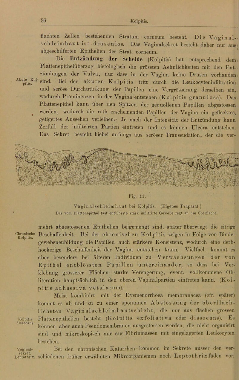 Kolpitis. flachten Zellen bestehenden Stratum corneum besteht. Die Vaginal- schi e im haut ist drüsenlos. Das Vaginalsekret besteht daher nur aus abgeschilferten Epithelien des Strat. corneum. Die Entzündung' der Scheide (Kolpitis) hat entsprechend dem Plattenepithelüberzug histologisch die grössten Aehnlichkeiten mit den Ent- zündungen der Vulva, nur dass in der Vagina keine Drüsen vorhanden AkUpftis^’°1' sind. Bei der akuten Kolpitis tritt durch die Leukocyteninfiltration und seröse Durchtränkung der Papillen eine Vergrösserung derselben ein, wodurch Prominenzen in der Vagina entstehen (Kolpitis granulosa). Das Plattenepithel kann über den Spitzen der gequollenen Papillen abgestossen t werden, wodurch die roth erscheinenden Papillen der Vagina ein geflecktes, getigertes Aussehen verleihen.- Je nach der Intensität der Entzündung kann Zerfall der infiltrirten Partien eintreten und es können Ulcera entstehen. Das Sekret besteht hiebei anfangs aus seröser Transsudation, der die ver- Vaginalsch leim haut bei Kolpitis. (Eigenes Präparat.) Das vom Plattenepithel fast entblösste stark infiltrirte Gewebe ragt an die Oberfläche. mehrt abgestossenen Epithelien beigemengt sind, später überwiegt die eitrige Chronische Beschaffenheit. Bei der chronischen Kolpitis zeigen in Folge von Binde- gewebsneubildung die Papillen auch stärkere Konsistenz, wodurch eine derb- höckerige Beschaffenheit der Vagina entstehen kann. Vielfach kommt es aber besonders bei älteren Individuen zu Verwachsungen der von Epithel entblössten Papillen untereinander, so dass bei Ver- klebung grösserer Flächen starke Verengerung, event. vollkommene Ob- literation hauptsächlich in den oberen Vaginalpartien eintreten kann. (Kol- pitis adhaesiva vetularum). Meist kombinirt mit der Dysmenorrhöen membranacea (cfr. später) kommt es ab und zu zu einer spontanen Abstossung der oberfläch- lichsten Vaginalschleimhautschicht, die nur aus flachen grossen Kolpitis Plattenepithelien besteht (Kolpitis exfoliativa oder dissecans). Es d]-socans. können aker au0^ pseudomembranen ausgestossen werden, die nicht organisirt sind und mikroskopisch nur aus Fibrinmassen mit eingelagerten Leukocyten bestehen. Vaginal- Bei den chronischen Katarrhen kommen im Sekrete ausser den ver- Loptothrix. schiedenen früher erwähnten Mikroorganismen noch Leptothrixfäden vor,