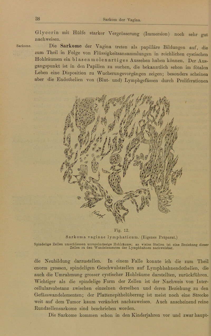 Sarkome. Glycerin mit Hülfe starker Vergrösserung (Immersion) noch sehr gut nachweisen. Die Sarkome der Vagina treten als papilläre Bildungen auf, die zum 1 heil in Folge von Flüssigkeitsansammlungen in reichlichen cystischen Hohlräumen ein blasen molenartiges Aussehen haben können. Der Aus- gangspunkt ist in den Papillen zu suchen, die bekanntlich schon im fötalen Leben eine Disposition zu Wucherungsvorgängen zeigen; besonders scheinen aber die Endothelien von (Blut- und) Lymphgefässen durch Proliferationen mm Fig. 12. Sarkoma vaginae lympkaticum. (Eigenes Präparat.) Spindelige Zellen umsohliessen unregelmässige Hohlräume; an vielen Stellen ist eine Beziehung dieser Zellen zu den Wandelementen der Lymphbahnen nachweisbar. die Neubildung darzustellen. In einem Falle konnte ich die zum Theil enorm grossen, spindeligen Geschwulstzellen auf Lymphbahnendothelien, die auch die Umrahmung grosser cystischer Hohlräume darstellten, zurückführen. Wichtiger als die spindelige Form der Zellen ist der Nachweis von Inter- cellularsubstanz zwischen einzelnen derselben und deren Beziehung zu den Gefässwandelementen; der Plattenepithelüberzug ist meist noch eine Strecke weit auf dem Tumor kaum verändert nachzuweiseu. Auch anscheinend reine Rundzellensarkome sind beschrieben worden. Die Sarkome kommen schon in den Kinderjahreu vor und zwar haupt-