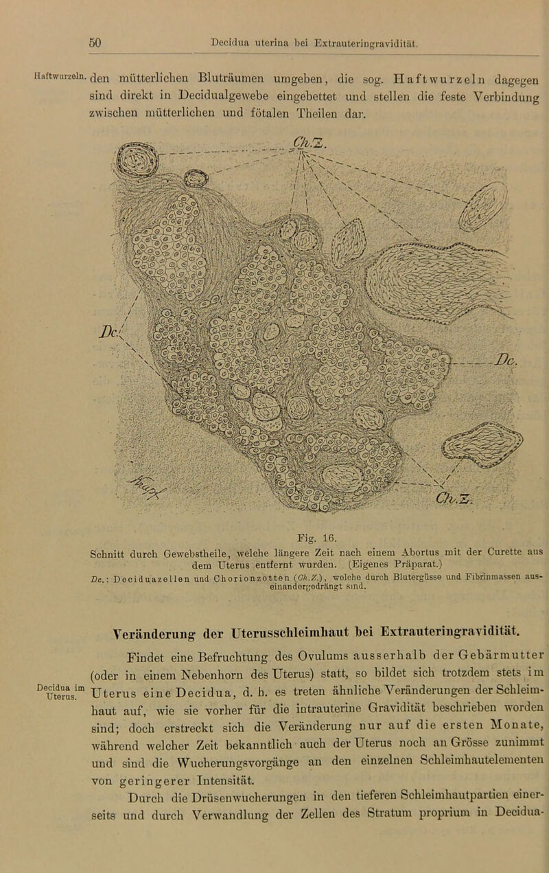 Haftwnrzein. den mütterlichen Bluträumen umgeben, die sog. Haft wurzeln dagegen sind direkt in Decidualgewebe eingebettet und stellen die feste Verbindung zwischen mütterlichen und fötalen Theilen dar. Fig. 16. Schnitt durch Gewebstheile, welche längere Zeit nach einem Abortus mit der Curette aus dem Uterus entfernt wurden. (Eigenes Präparat.) Dc.\ Deciduazel len und Chorionzotten (Gh.Z.), welche durch Blutergüsse und Fihrinmassen aus- einandergedrängt sind. Veränderung der Uterussclileimliaut bei Extrauteringravidität. Findet eine Befruchtung des Ovulums ausserhalb der Gebärmutter (oder in einem Nebenhorn des Uterus) statt, so bildet sich trotzdem stets i m Dutderusim Uterus eine Decidua, d. h. es treten ähnliche Veränderungen der Schleim- haut auf, wie sie vorher für die intrauterine Gravidität beschrieben worden sind; doch erstreckt sich die Veränderung nur auf die ersten Monate, während welcher Zeit bekanntlich auch der Uterus noch an Grösse zunimmt und sind die Wucherungsvorgänge an den einzelnen Schleimhautelementen von geringerer Intensität. Durch die Drüsenwucherungen in den tieferen Schleimhautpartien einer- seits und durch Verwandlung der Zellen des Stratum proprium in Decidua-