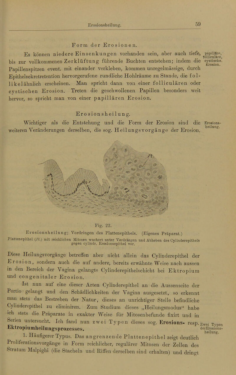 Form der Erosionen. Es können niedere Ein Senkungen vorhanden sein, aber auch tiefe, papilläre, # follicalarG, bis zur vollkommenen Zerklüftung führende Buchten entstehen; indem die oystische. _ t Erosion. Papillenspitzen event. mit einander verkleben, kommen unregelmässige, durch Epithelsekretretention hervorgerufene rundliche Hohlräume zuStande, die fol- likelähnlich erscheinen. Mau spricht dann von einer folliculären oder cystischen Erosion. Treten die geschwollenen Papillen besonders tveit hervor, so spricht man von einer papillären Erosion. Erosionsheilung. Wichtiger als die Entstehung und die Form der Erosion sind die Erosions- Weiteren Veränderungen derselben, die sog. Heilungsvorgänge der Erosion. Erosionsheilnng; Vordringen des Plattenepithels. (Eigenes Präparat.) Piattenepilhel (PL) mit reichlichen Mitosen wuchert unter Verdrängen und Äbheben des Cylinderepithels gegen cylindr. Erosionsepithel vor. Diese Heilungsvorgänge betreffen aber nicht allein das Cylinderepithel der Eiosion, sondern auch die auf andere, bereits erwähnte Weise nach aussen in den Bereich der Vagina gelangte Cylinderepithelschicht bei Ektropium und congenitaler Erosion. Ist nun aut eine dieser Arten Cylinderepithel an die Aussenseite der Portio gelangt und den Schädlichkeiten der Vagina ausgesetzt, so erkennt man stets das Bestreben der Natur, dieses an unrichtiger Stelle befindliche Cylinderepithel zu eliminiren. Zum Studium dieses „Heilungsmodus“ habe ich stets die Präparate in exakter Weise für Mitosenbefunde fixirt und in Serien untersucht. Ich fand nun zwei Typen dieses sog. Erosions- resp.Zwoi Typen Ektropiumheilungsprozesses. dorErostons- 1 TT ß heilung. 1. Häufigerer Typus. Das angrenzende Plattenepithel zeigt deutlich Proliferationsvorgänge in Form reichlicher, regulärer Mitosen der Zellen des Stratum Malpighi (die Stacheln und Riffen derselben sind erhalten) und dringt