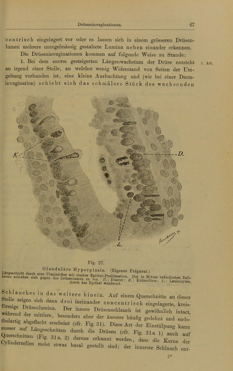 centrisch eingelagert vor oder es lassen sich in einem grösseren Drüsen- lumen mehrere unregelmässig gestaltete Lumina neben einander erkennen. Die Drüseniuvagiuationen kommen auf folgende Weise zu Stande: 1. Bei dem enorm gesteigerten Längenwachstum der Drüse entsteht an irgend einer Stelle, an welcher wenig Widerstand von Seiten der Um- gebung vorhanden ist, eine kleine Ausbuchtung und (wie bei einer Darm- invagination) schiebt sich das schmälere Stück des wachsenden Fig. 27. tw« i, , Glanduläre Hyperplasie. (Eigenes Präparat.) SohUuohes.in das weitere hinein. Auf einem Querschnitte au dieser “f drel '«'ander concentriseh eingelagerte, kreis- whZddr6 r,na’, inDere D''08“8«1'1«'-* it gewöhnlich intact, .TI“' TT’ , “ “ber ^ “USSere i,iiufi« gedehnt und endo- ausser auf tI” T' ^ ^ ^ Art der Ei8“«rg kann • angeschnitten durch die Drüsen (cfr. Fig. 31a 1) auch auf Querschnitten (Fig. 3la, 2, daraus erkannt werden, dass die Kerne de Cyhnderzellen meist etwas basa, gestellt sind; der innerste Schlag ent- 1. Art.