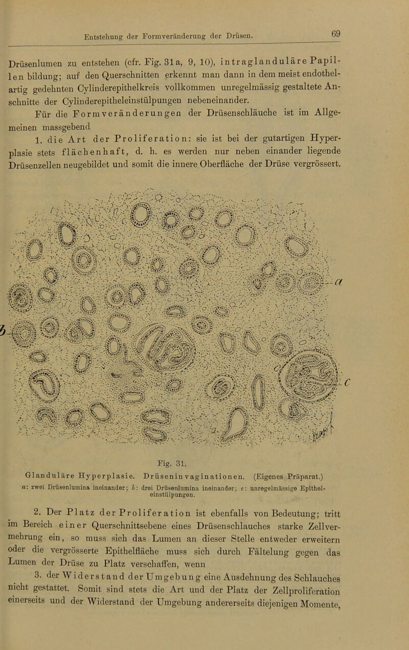 Entstehung der Formveränderung der Drüsen Drüsenlumen zu entstehen (cfr. Fig. 31a, 9, 10), intraglanduläre Papil- len bildung; auf den Querschnitten erkennt ruan dann in dem meist endothel- artig gedehnten Cylinderepithelkreis vollkommen unregelmässig gestaltete An- schnitte der Cylinderepitheleinstülpungen nebeneinander. Für die Form Veränderungen der Drüsenschläuche ist im Allge- meinen massgebend 1. die Art der Proliferation: sie ist bei der gutartigen Hyper- plasie stets flächenhaft, d. h. es werden nur neben einander liegende Drüsenzellen neugebildet und somit die innere Oberfläche der Drüse vergrössert. Fig. 31. Glanduläre Hyperplasie. Drüsenin vaginationen. (Eigenes Präparat.) a: zwei Drüsenlumina ineinander; h: drei Drüsenlumina ineinander; c: unregelmässige Epithel- einstülpungen. 2. Der Platz der Proliferation ist ebenfalls von Bedeutung; tritt im Bereich einer Querschnittsebene eines Drüsenschlaucbes starke Zell Ver- mehrung ein, so muss sicli das Lumen an dieser Stelle entweder erweitern oder die vergrösserte Epithelfläche muss sich durch Fältelung gegen das Lumen der Drüse zu Platz verschaffen, wenn 3. der Widerstand der Umgebung eine Ausdehnung des Schlauches nicht gestattet. Somit sind stets die Art und der Platz der Zellproliferation einerseits und der Widerstand der Umgebung andererseits diejenigen Momente,