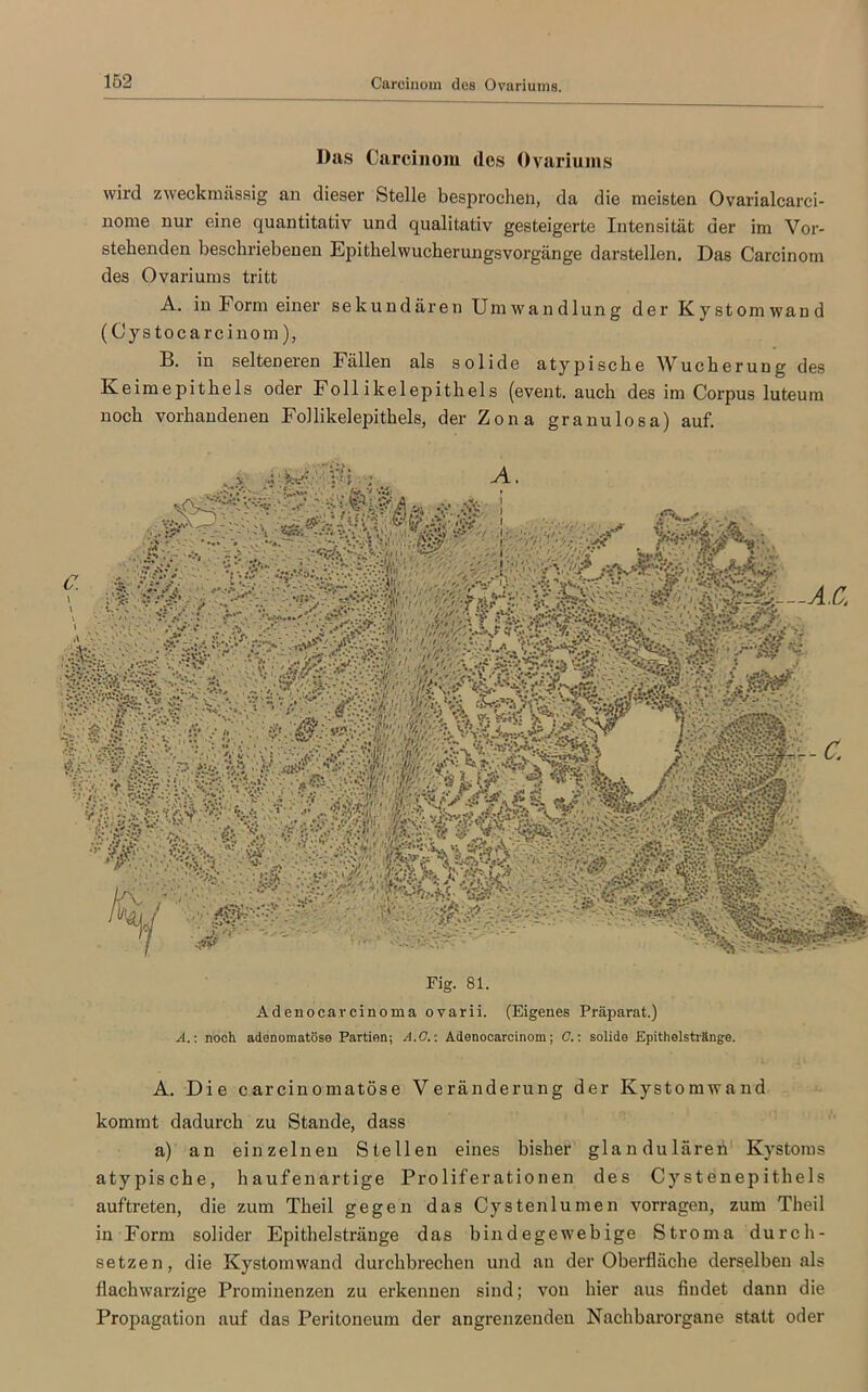 Das Carcinom des Ovariums wird zweckmässig an dieser Stelle besprochen, da die meisten Ovarialcarci- nome nur eine quantitativ und qualitativ gesteigerte Intensität der im Vor- stehenden beschriebenen Epithelwucherungsvorgänge darstellen. Das Carcinom des Ovariums tritt A. in Form einer sekundären Umwandlung der Kystomwand (C y s to c a r c i n o m), B. in selteneren Fällen als solide atypische Wucherung des Keimepithels oder Follikelepithels (event. auch des im Corpus luteum noch vorhandenen Follikelepithels, der Zona granulosa) auf. Fig. 81. Adenocarcinoma ovarii. (Eigenes Präparat.) A.: noch adenomatöse Partien; A.G. ■: Adenocarcinom; C.: solide Epithelstränge. A. Die carcinomatöse Veränderung der Kystomwand kommt dadurch zu Stande, dass a) an einzelnen Stellen eines bisher glandulären Kystoms atypische, haufenartige Proliferationen des Cystenepithels auftreten, die zum Theil gegen das Cystenlumen vorragen, zum Theil in Form solider Epithelsträuge das bindegewebige Stroma durch- setzen, die Kystomwand durchbrechen und an der Oberfläche derselben als flachwarzige Prominenzen zu erkennen sind; von hier aus findet dann die Propagation auf das Peritoneum der angrenzenden Nachbarorgane statt oder