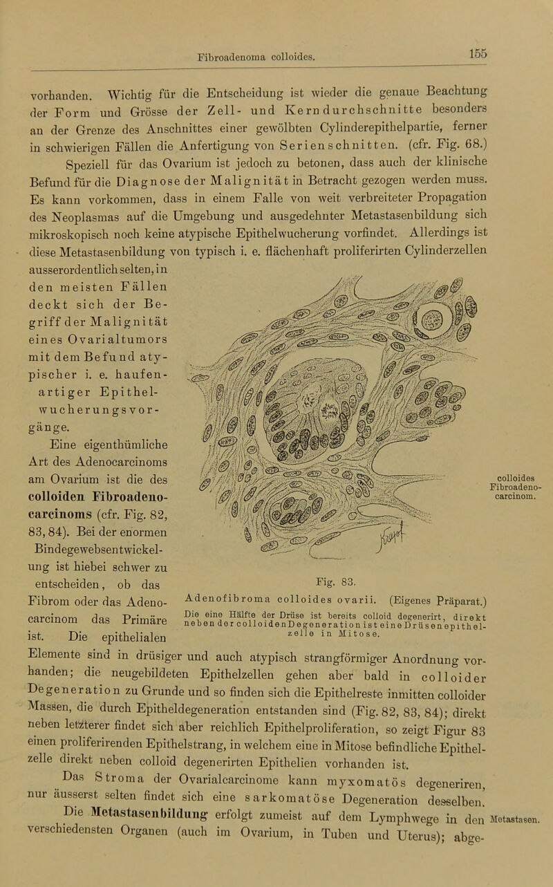 Fibroadenoma colloides. vorhanden. Wichtig für die Entscheidung ist wieder die genaue Beachtung der Form und Grösse der Zell- und Kern durchschnitte besonders an der Grenze des Anschnittes einer gewölbten Cylinderepithelpartie, ferner in schwierigen Fällen die Anfertigung von Ser ien s ch ni t ten. (cfr. Fig. 68.) Speziell für das Ovarium ist jedoch zu betonen, dass auch der klinische Befund für die Diagnose der Malignität in Betracht gezogen werden muss. Es kann Vorkommen, dass in einem Falle von weit verbreiteter Propagation des Neoplasmas auf die Umgebung und ausgedehnter Metastasenbildung sich mikroskopisch noch keine atypische Epithelwucherung vorfindet. Allerdings ist diese Metastasenbildung vou typisch i. e. flächenhaft proliferirten Cylinderzellen ausserordentlich selten, in den meisten Fällen deckt sich der Be- griff der Malignität eines Ovarialtumors mit dem Befu ud aty- pischer i. e. haufen- artiger Epithel- wucherungsvor- gänge. Eine eigenthiimliche Art des Adenocarcinoms am Ovarium ist die des colloiden Fibroadeno- carcinoms (cfr. Fig. 82, 83, 84). Bei der enormen Bindegewebsentwickel- ung ist hiebei schwer zu entscheiden, ob das Fibrom oder das Adeuo- carcinom das Primäre ist. Die epithelialen Elemente sind in drüsiger und auch atypisch strangförmiger Anordnung vor- handen; die neugebildeten Epithelzellen gehen aber bald in colloider Degeneration zu Grunde und so finden sich die Epithelreste inmitten colloider Massen, die durch Epitheldegeneration entstanden sind (Fig. 82, 83, 84); direkt neben letzterer findet sich aber reichlich Epithelproliferation, so zeigt Figur 83 einen proliferirenden Epithelstrang, in welchem eine in Mitose befindliche Epithel- zelle direkt neben colloid degenerirten Epithelien vorhanden ist. Das Stroma der Ovarialcarcinome kann myxomatös degeneriren, nur ausserst selten findet sich eine sarkomatöse Degeneration desselben! Die Metastasenbildung erfolgt zumeist auf dem Lymphwege in den’ Metastasen, verschiedensten Organen (auch im Ovarium, in Tuben und Uterus); abge- colloides Fibroadeno- carcinom. Adenofibroma colloides ovarii. (Eigenes Präparat.) Die eine Hälfte der Drüse ist bereits colloid degenerirt, direkt neben der colloidenDegeneration ist eineDriisenepithel- zelle in Mitose.