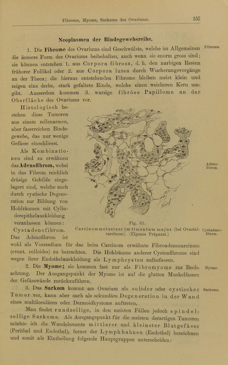 Fibrome, Myome, Sarkome des Ovariums. Neoplasmen (1er Bimlegewebsreihe. 1. Die Fibrome des Ovariums sind Geschwülste, welche im Allgemeinen die äussere Form des Ovariums beibehalten, auch wenn sie enorm gross sind; sie können entstehen 1. aus Corpora fibrosa, d. h. den narbigen Resten früherer Follikel oder 2. aus Corpora lutea durch Wucherungsvorgänge an der Theca; die hieraus entstehenden Fibrome bleiben meist klein und zeigen eine derbe, stark gefaltete Rinde, welche einen weicheren Kern um- gibt. Ausserdem kommen 3. warzige fibröse Papillome an der Oberfläche des Ovariums vor. Histologisch be- stehen diese Tumoren aus einem zellenarmen, aber faserreichen Binde- gewebe, das nur wenige Gefässe einschliesst. Als Kombinatio- nen sind zu erwähnen dasAdenoiibrom, wobei in das Fibrom reichlich drüsige Gebilde einge- lagert sind, welche auch durch cystische Degene- ration zur Bildung von Hohlräumen mit Cylin- derepithelauskleidung veranlassen können: Cystadenofibrom. Carcinommetastase im Omentum majus (bei Ovarial- T, , . ... . carcinom). (Eigenes Präparat.) Das Adenofibrom ist wohl als Vorstadium für das beim Carcinom erwähnte Fibroadenocarcinom (event. colloides) zu betrachten. Die Hohlräume anderer Cystenfibrome sind wegen ihrer Endothelauskleidung als Lymphcysten aufzufassen. 2. Die Myome; sie kommen fast nur als Fibromyome zur Beob- achtung. Der Ausgangspunkt der Myome ist auf die glatten Muskelfasern der Gefässwände zurückzuführen. 3. Das Sarkom kommt am Ovarium als solider oder cystischer Tumor vor, kann aber auch als sekundäre Degen eration in der Wand eines multiloculären oder Dermoidkystoms auftreten. Man findet rundzellige, in den meisten Fällen jedoch spindel- zellige Sarkome. Als Ausgangspunkt für die meisten derartigen Tumoren möchte ich die Wandelemente mittlerer und kleinster Blutgefässe (Perithel und Endothel), ferner der Lymph bahnen (Endothel) bezeichnen und somit als Eintheilung folgende Hauptgruppen unterscheiden: Fig. 85. Fibrome. Adeno- fibrom. Cystadeno- fibrom. Myome. Sarkome.