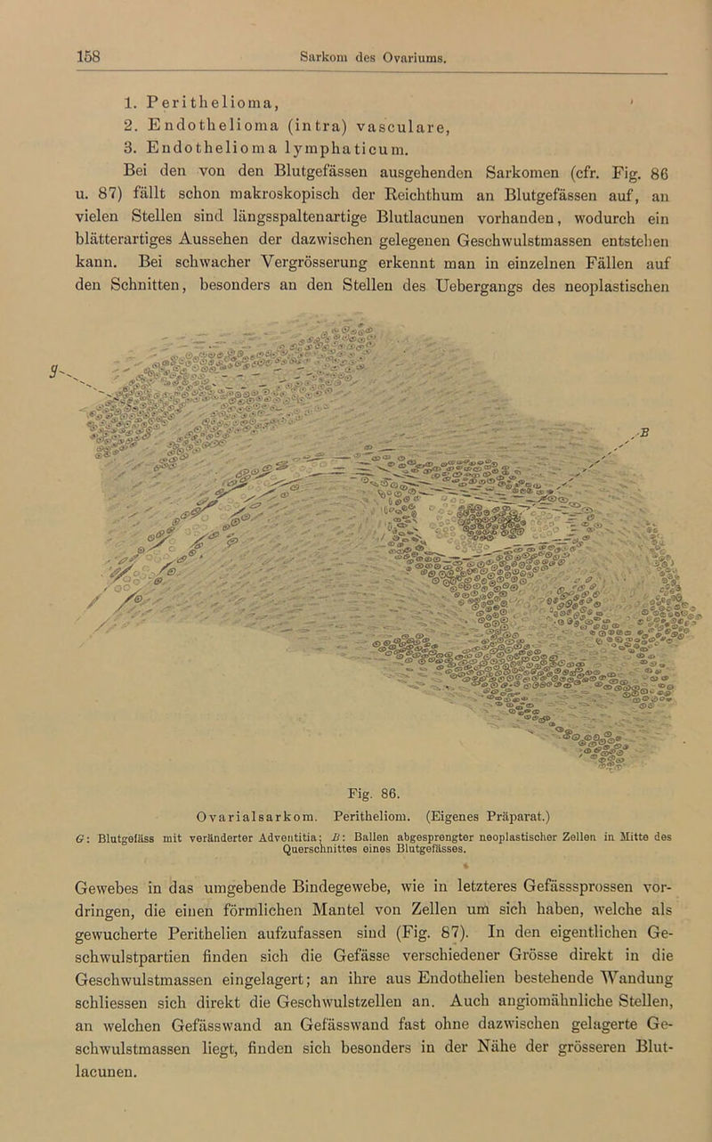 1. Perithelioma, » 2. Endotbelioma (intra) vasculare, 3. Endotbelioma lymphaticum. Bei den von den Blutgefässen ausgebenden Sarkomen (cfr. Fig. 86 u. 87) fällt schon makroskopisch der Beichthum an Blutgefässen auf, an vielen Stellen sind längsspaltenartige Blutlacunen vorhanden, wodurch ein blätterartiges Aussehen der dazwischen gelegenen Geschwulstmassen entstehen kann. Bei schwacher Vergrösserung erkennt man in einzelnen Fällen auf den Schnitten, besonders an den Stellen des Uebergangs des neoplastischen ' ,,, c'/* , ■ . '£/. 'e , & . /o //■ ■ ' % ■B — - i • ^ A,- ■ &&,-■ : - . ‘V&SSgo ?'®|®g pifaZSi * ‘ ®6 Ns«i '■V, • 3% _ C ©o ©JasoO^ r. «0*90 f ns9%P Fig. 86. Ovarialsarkom. Peritheliom. (Eigenes Präparat.) G: Blutgefäss mit veränderter Adventitia; B: Ballen abgesprengter neoplastischer Zellen in Mitte des Querschnittes eines Blutgefässes. 4 Gewebes in das umgebende Bindegewebe, wie in letzteres Gefässsprossen Vor- dringen, die einen förmlichen Mantel von Zellen um sich haben, welche als gewucherte Perithelien aufzufassen sind (Fig. 87). In den eigentlichen Ge- schwulstpartien finden sich die Gefässe verschiedener Grösse direkt in die Geschwulstmassen eingelagert; an ihre aus Endothelien bestehende Wandung schliessen sich direkt die Geschwulstzellen an. Auch augiomähnliche Stellen, an welchen Gefässwand an Gefässwand fast ohne dazwischen gelagerte Ge- schwulstmassen liegt, finden sich besonders in der Nähe der grösseren Blut- lacunen.