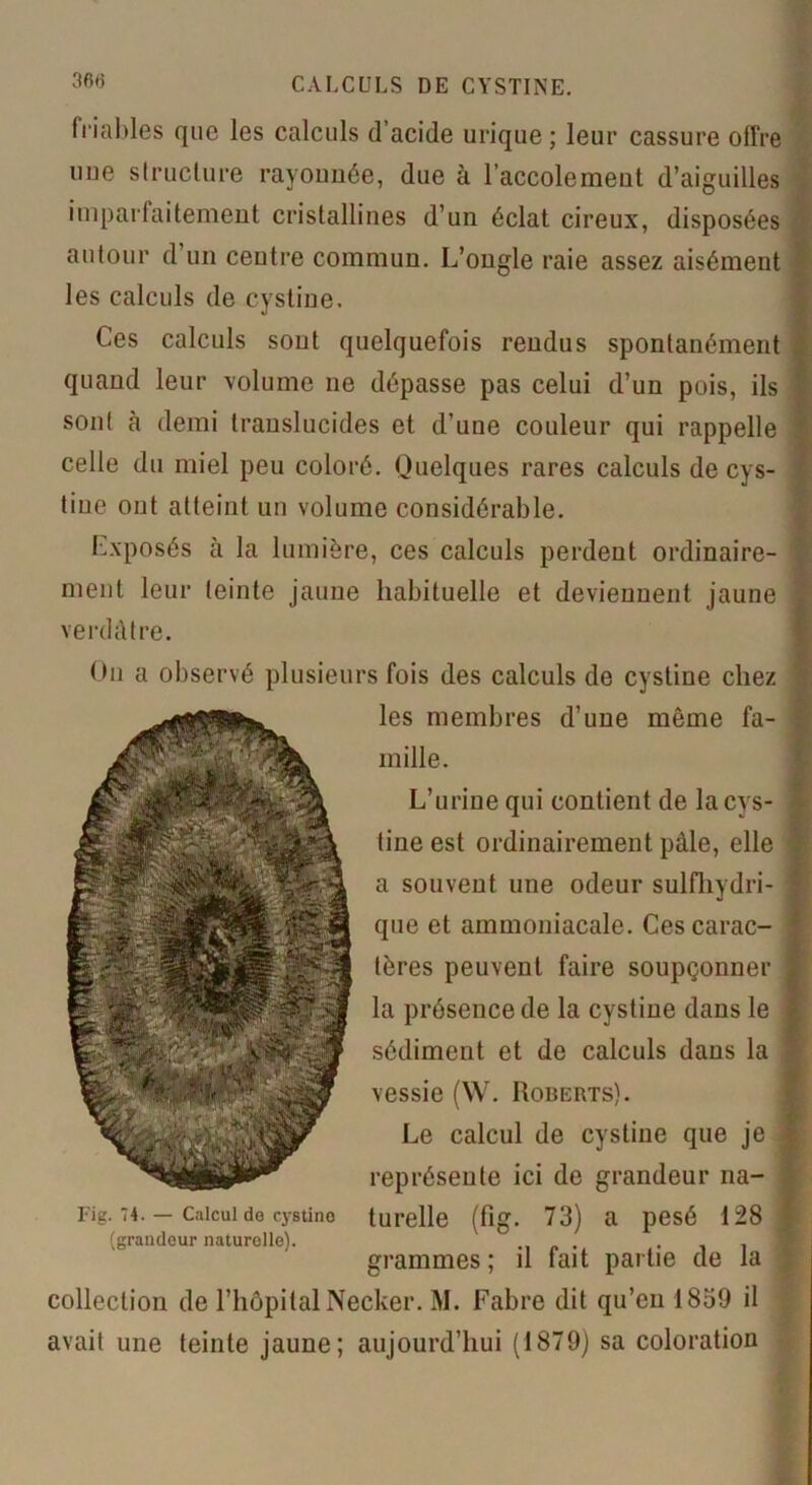 friables que les calculs d’acide urique; leur cassure offre une structure rayonnée, due à l’accolement d’aiguilles imparfaitement cristallines d’un éclat cireux, disposées autour d’un centre commun. L’ongle raie assez aisément les calculs de cystine. Ces calculs sont quelquefois rendus spontanément quand leur volume ne dépasse pas celui d’un pois, ils sont à demi translucides et d’une couleur qui rappelle celle du miel peu coloré. Quelques rares calculs de cys- tine ont atteint un volume considérable. Exposés à la lumière, ces calculs perdent ordinaire- ment leur teinte jaune habituelle et deviennent jaune verdâtre. On a observé plusieurs fois des calculs de cystine chez les membres d’une môme fa- mille. L’urine qui contient de la cys- tine est ordinairement pâle, elle a souvent une odeur sulfhydri- que et ammoniacale. Ces carac- tères peuvent faire soupçonner la présence de la cystine dans le sédiment et de calculs dans la vessie (W. Roberts). Le calcul de cystine que je représente ici de grandeur na- i-ig. *4. — Calcul de cystino turelle (fig. 73) a pesé 128 ; (grandeur naturelle). -in- . . grammes; il fait partie de la collection de l’hôpital Necker. M. Fabre dit qu’en 1859 il avait une teinte jaune; aujourd’hui (1879) sa coloration