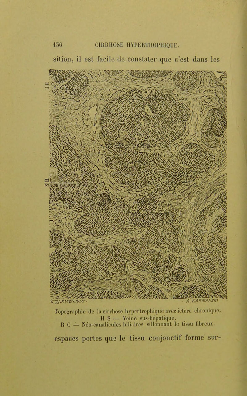 silion, il est facile de constater que c'est dans les Topographie de la cirrhose hYpcrlropiiique avec iclère chronique. II S — Veine sus-iicpatique. B C — ISéo-canalicules biliaires sillonnant le tissu fibreux. espaces portes que le tissu conjouctif forme sur-