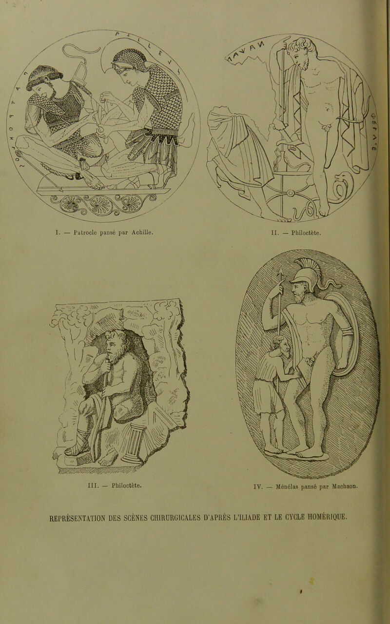 REPRÉSENTATION DES SCÈNES CHIRURGICALES D’APRÈS L’ILIADE ET LE CYCLE HOMÉRIQUE. I