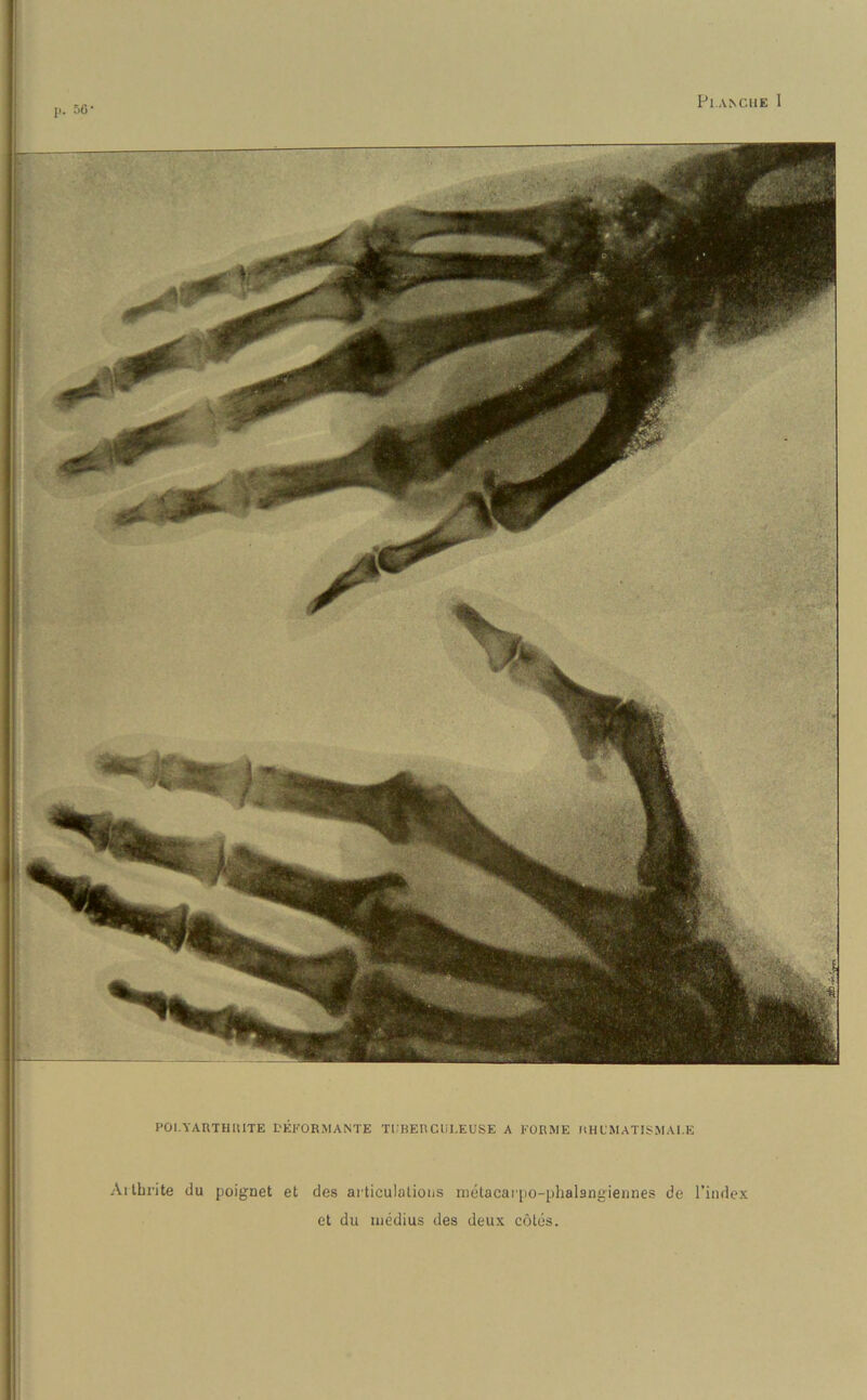 POI.YARTH IUTE DEFORM A N TE TUBERCUREUSE A FORME RHUMATISMAI.E Aithrite du poignet et des articulations metacarpo-phalangiennes de l’index et du inedius des deux cotes.