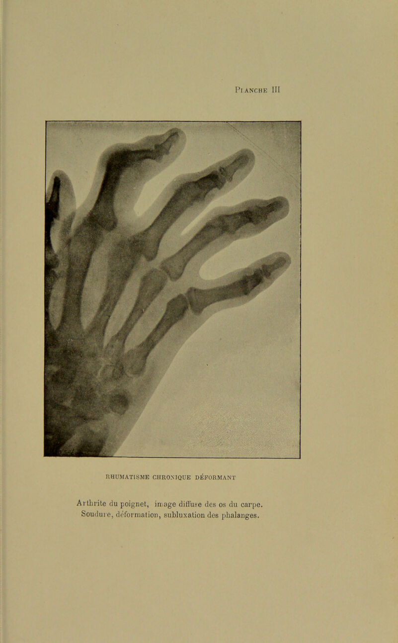 RHUMATISME CHRONFQUE DEFORMANT Arthrite du poignet, image diffuse des os du carpe. Soudui e, deformation, subluxation des phalanges.