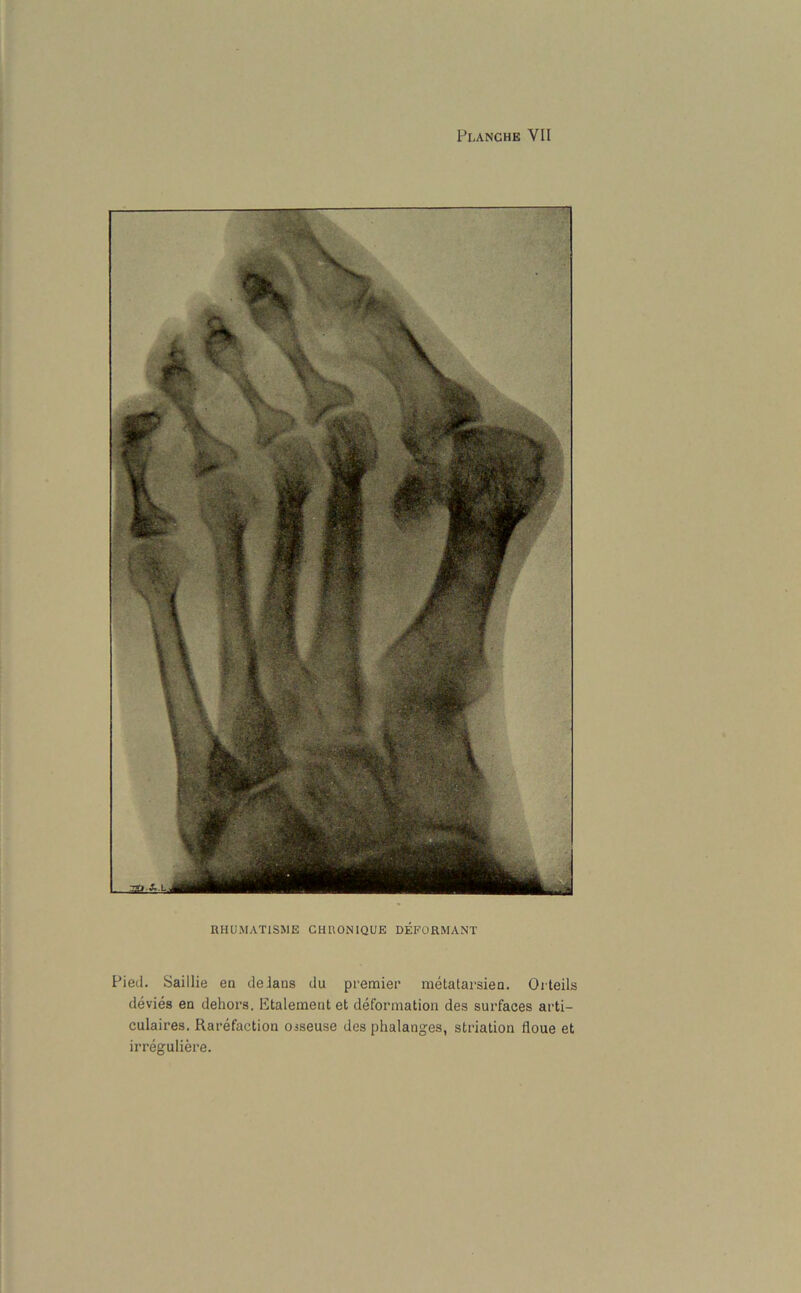 RHUMAT1SME CHRONIQUE DEFORMANT Pied. Saillie en deJans du premier metatarsien. Orteils devies en dehors. Etalement et deformation des surfaces arti- culaires. Rarefaction osseuse des phalanges, striation floue et irreguliere.