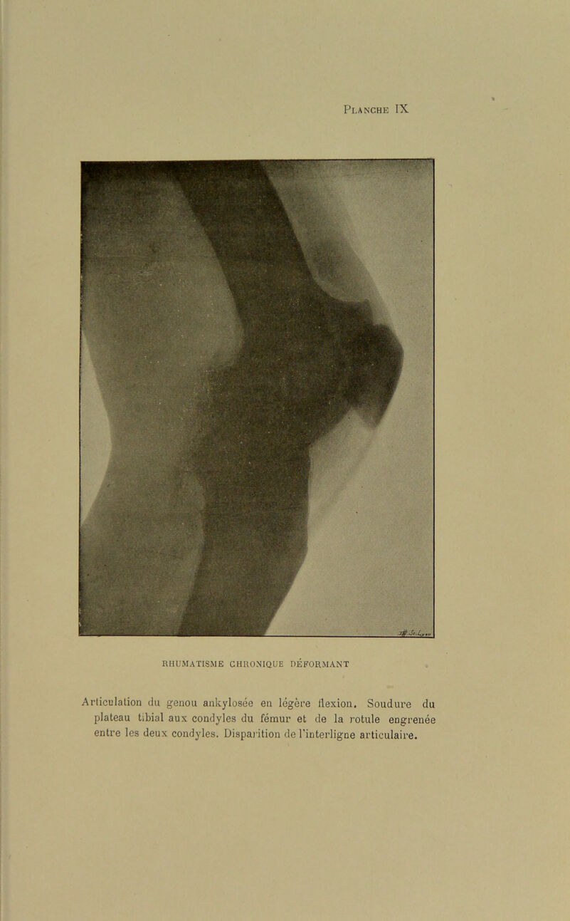 RHUMATISME CHRONIQUE DEFORMANT Arliculation du genou ankylosee eu legere flexion. Soudure du plateau tibial aux condyles du femur et de la rotule eDgrenee entre les deux condyles. Disparition de l’interligne articulaire.