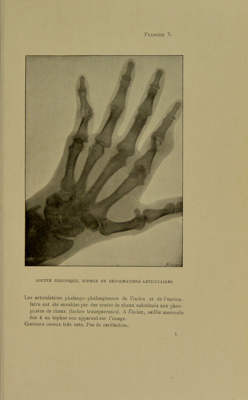 GOUTTE CHRONIQUE. TOPHUS ET DEFORMATIONS ARTIGULAIRES Les articulations phalango- phalangiennes de l’index et de Pauricu- laire ont ete envahiespar des urates de cliaux substitues aux phos- phates de chaux (taches transparentcs). A l’index, saillie anormale due a un tophus non apparent sur l’image. Contours osseux tres nets. Pas de rarefaction. b