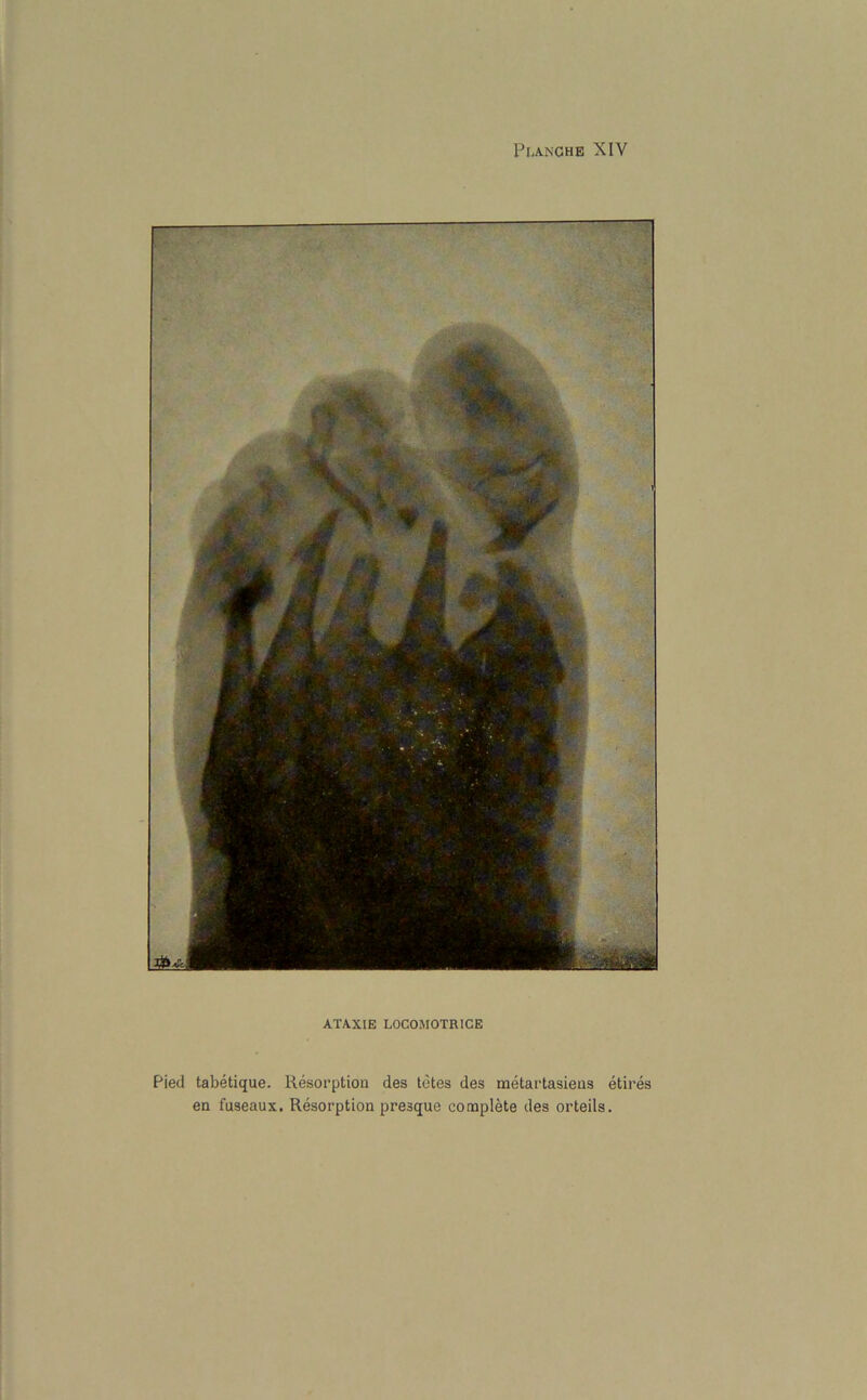 ATAXIE L0C0M0TR1CE Pied tabetique. Resorption des totes des metartasiens etires en fuseaux. Resorption presque complete des orteils.