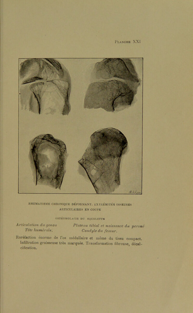 RHUMATISME CHRONIQUE DEEORMANT. EXT REMITES OSSEUSES ARTICULAIRES EN COUPE OSTEOMOLAOIE DU SQUELETTE Ailiculation du genou Plateau tibial el naissance du perone Tele humerale. Condyle du femur. Rarefaction enorme de l’os medullaire et meme du tissu compact. Infiltration graisseuse tres marquee. Transformation fibreuse, decal- cification.