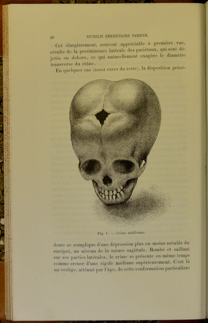 Cet élargissement, souvent appréciable à première vue. résulte (le la proéminence latérale des pariétaux, qui sont dé- jetés en dehors, ce qui naturellement exagère le diamètre transverse du crâne. En quelques cas (assez rares du reste), la disposition prece- Fig. 1. — Cràue natifovme. dente se complique d'une dépression plus ou moins notable du sinciput, au niveau de la suture sagittale. Bombé et saillant sur ses parties latérales, le crâne se présente en même temps comme creusé d'une rigole médiane supérieurement. C'est là un vestige, atténué par l'âge, de cette conformation particulière