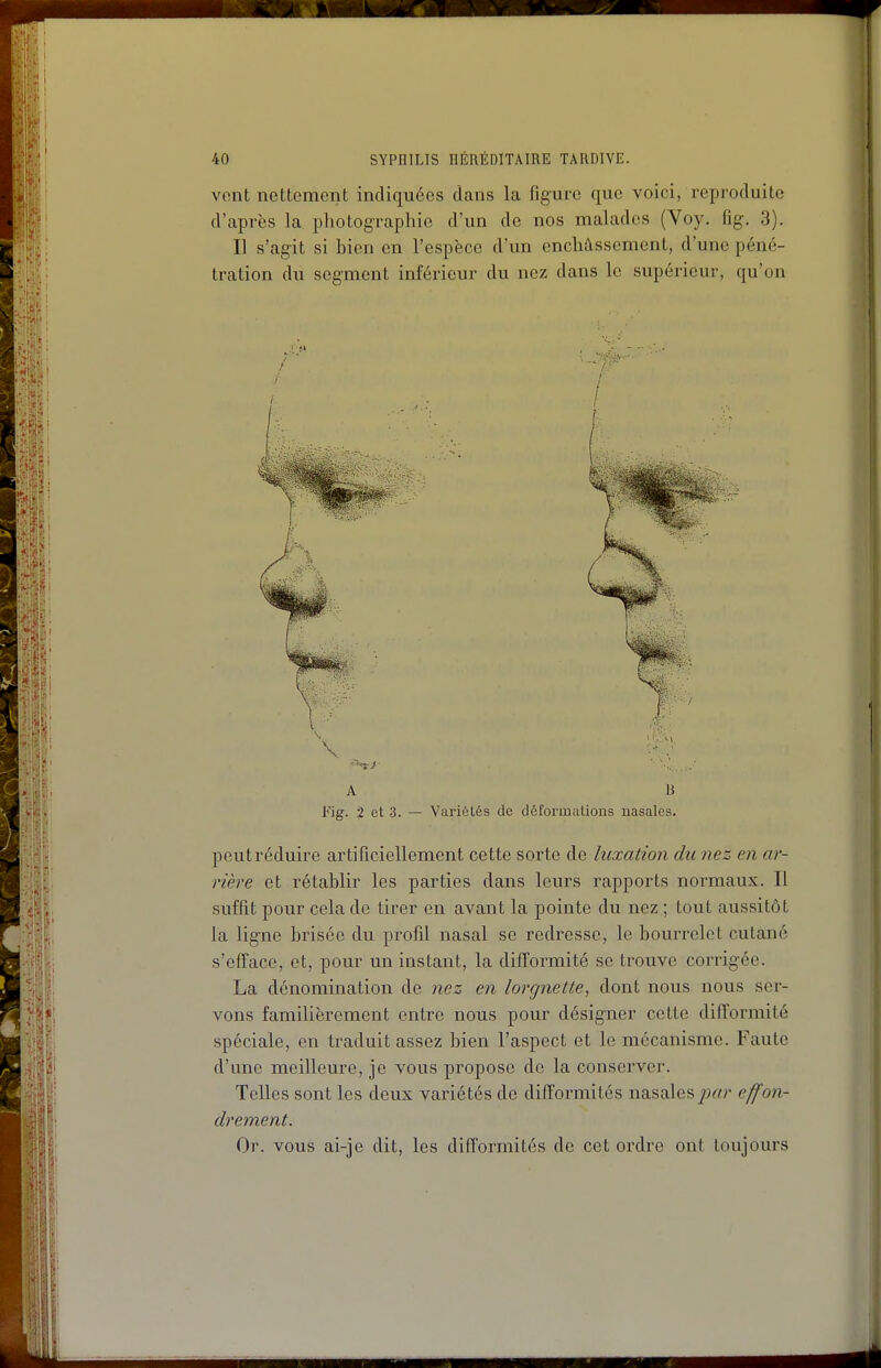 vont nettement indiquées dans la figure que voici, reproduite d'après la photographie d'un de nos malades (Voy. fig. 3). Il s'agit si bien en l'espèce d'un enchâssement, d'une péné- tration du segment inférieur du nez dans le supérieur, qu'on A B Fig. 2 et 3. — Variélés de déformations nasales. peut réduire artificiellement cette sorte de luxation du nez en ar- rière et rétablir les parties dans leurs rapports normaux. Il suffit pour cela de tirer en avant la pointe du nez ; tout aussitôt la ligne brisée du profil nasal se redresse, le bourrelet cutané s'efface, et, pour un instant, la difformité se trouve corrigée. La dénomination de nez en lorgnette, dont nous nous ser- vons familièrement entre nous pour désigner cette difformité spéciale, en traduit assez bien l'aspect et le mécanisme. Faute d'une meilleure, je vous propose de la conserver. Telles sont les deux variétés de difformités nasales par effon- drement. Or. vous ai-Jc dit, les difformités de cet ordre ont toujours