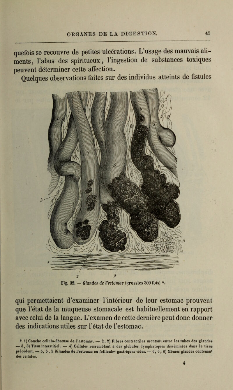 quefois se recouvre de petites ulcérations. L’usage des mauvais ali- ments, l’abus des spiritueux, l’ingestion de substances toxiques peuvent déterminer cette affection. Quelques observations faites sur des individus atteints de fistules 2 2 Fig. 32. — Glandes de l'estomac (grossies 300 fois) *. qui permettaient d’examiner l’intérieur de leur estomac prouvent que l’état de la muqueuse stomacale est habituellement en rapport avec celui de la langue. L’examen de cette dernière peut donc donner des indications utiles sur l’état de l’estomac. * I) Couche cellulo-fibreuse de l’estomac. — 2,2) Fibres contractiles montant entre les tubes des glandes — 3,3) Tissu interstitiel. — 4) Cellules ressemblant à des globules lymphatiques disséminées dans le tissa précédent. — 5,5,5 iGlaudes de l’estomac ou follicule1, gastriques vides.— 6, 6, 6) Mêmes glandes contenant des cellules.
