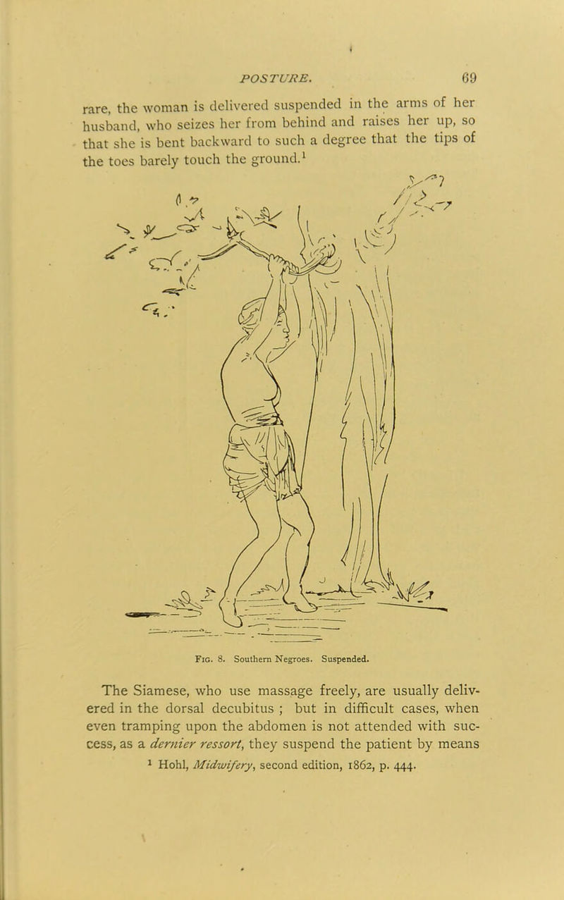 fiirc, the wonian is delivered suspended in the arms of her husband, who seizes her from behind and raises her up, so that she is bent backward to such a degree that the tips of the toes barely touch the ground.^ The Siamese, who use massage freely, are usually deliv- ered in the dorsal decubitus ; but in difficult cases, when even tramping upon the abdomen is not attended with suc- cess, as a dernier ressori, they suspend the patient by means ^ Hohl, Midwifery, second edition, 1862, p. 444.