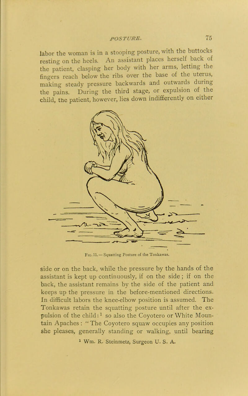 labor the woman is in a stooping posture, with the buttocks resting on the heels. An assistant places herself back of the patient, clasping her body with her arms, letting the fingers reach below the ribs over the base of the uterus, making steady pressure backwards and outwards during the pains. During the third stage, or expulsion of the child, the patient, however, lies down indifferently on either Fig. 11.— Squatting Posture of the Tonkawas. side or on the back, while the pressure by the hands of the assistant is kept up continuously, if on the side; if on the back, the assistant remains by the side of the patient and keeps up the pressure in the before-mentioned directions. In difficult labors the knee-elbow position is assumed. The Tonkawas retain the squatting posture until after the ex- pulsion of the child A so also the Coyotero or White Moun- tain Apaches : “ The Coyotero squaw occupies any position she pleases, generally standing or walking, until bearing 1 Wm. R. Steinmetz, Surgeon U. S. A.