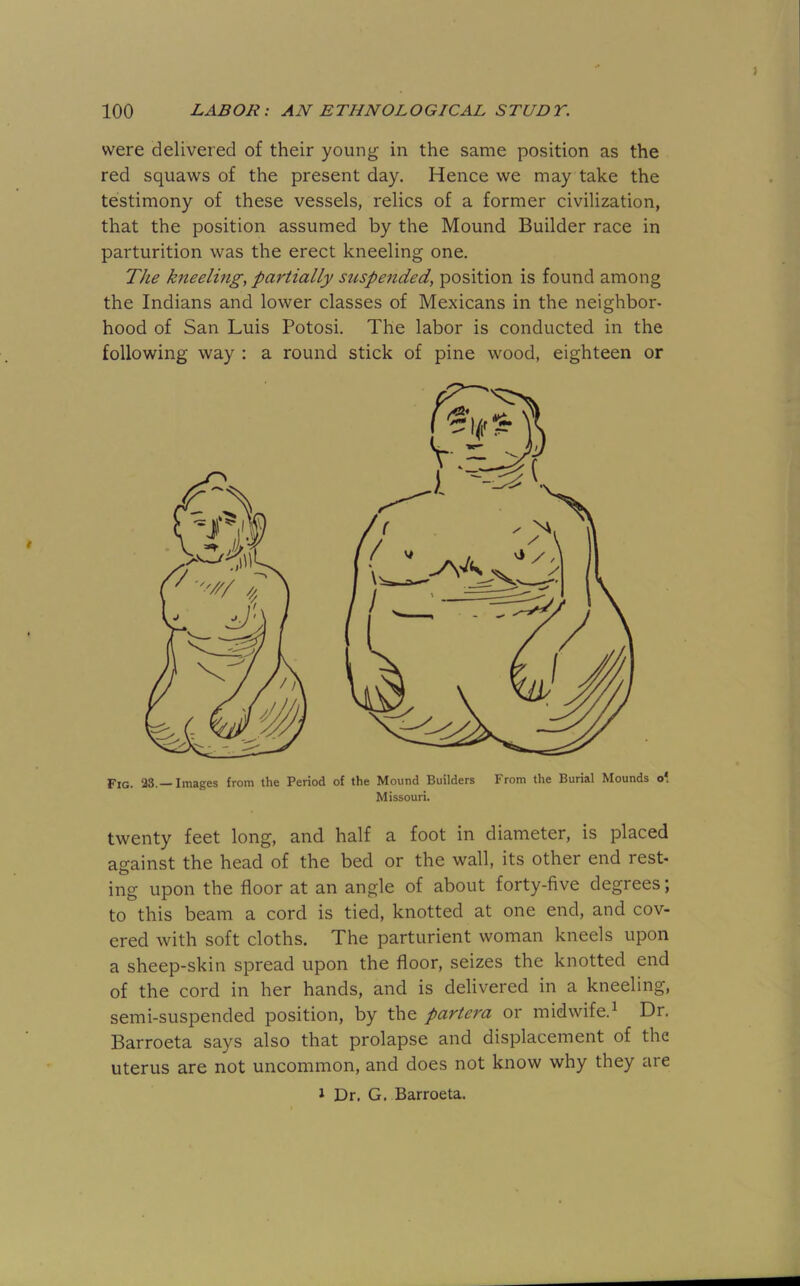 were delivered of their young in the same position as the red squaws of the present day. Hence we may take the testimony of these vessels, relics of a former civilization, that the position assumed by the Mound Builder race in parturition was the erect kneeling one. The kneeling, partially suspended, position is found among the Indians and lower classes of Mexicans in the neighbor- hood of San Luis Potosi. The labor is conducted in the following way : a round stick of pine wood, eighteen or Fig. 23.—Images from the Period of the Mound Builders From the Burial Mounds o* Missouri. twenty feet long, and half a foot in diameter, is placed against the head of the bed or the wall, its other end rest- ing upon the floor at an angle of about forty-five degrees; to this beam a cord is tied, knotted at one end, and cov- ered with soft cloths. The parturient woman kneels upon a sheep-skin spread upon the floor, seizes the knotted end of the cord in her hands, and is delivered in a kneeling, semi-suspended position, by the partera or midwife.^ Dr. Barroeta says also that prolapse and displacement of the uterus are not uncommon, and does not know why they are J Dr, G. Barroeta.