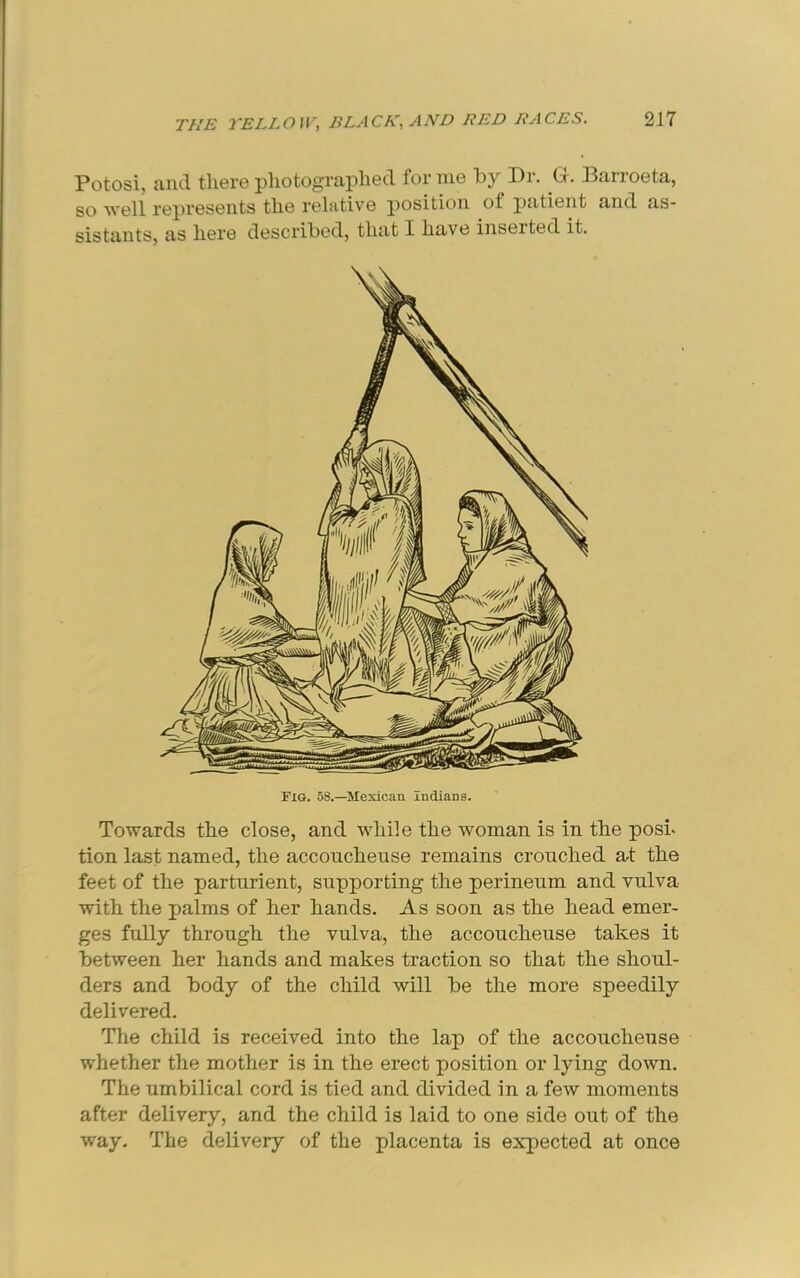 Potosi, and tlier©photogTaplied forme by Pi. P. Paiioeta, so Avell represents the relative position of patient and as- sistants, as here described, that I have inserted it. Towards the close, and while the woman is in the posi. tion last named, the accoucheuse remains crouched at the feet of the parturient, supporting the perineum and vulva with the palms of her hands. As soon as the head emer- ges fully through the vulva, the accoucheuse takes it between her hands and makes traction so that the shoul- ders and body of the child will be the more speedily delivered. The child is received into the lap of the accoucheuse whether the mother is in the erect position or lying down. The umbilical cord is tied and divided in a few moments after delivery, and the child is laid to one side out of the ■way. The delivery of the placenta is expected at once